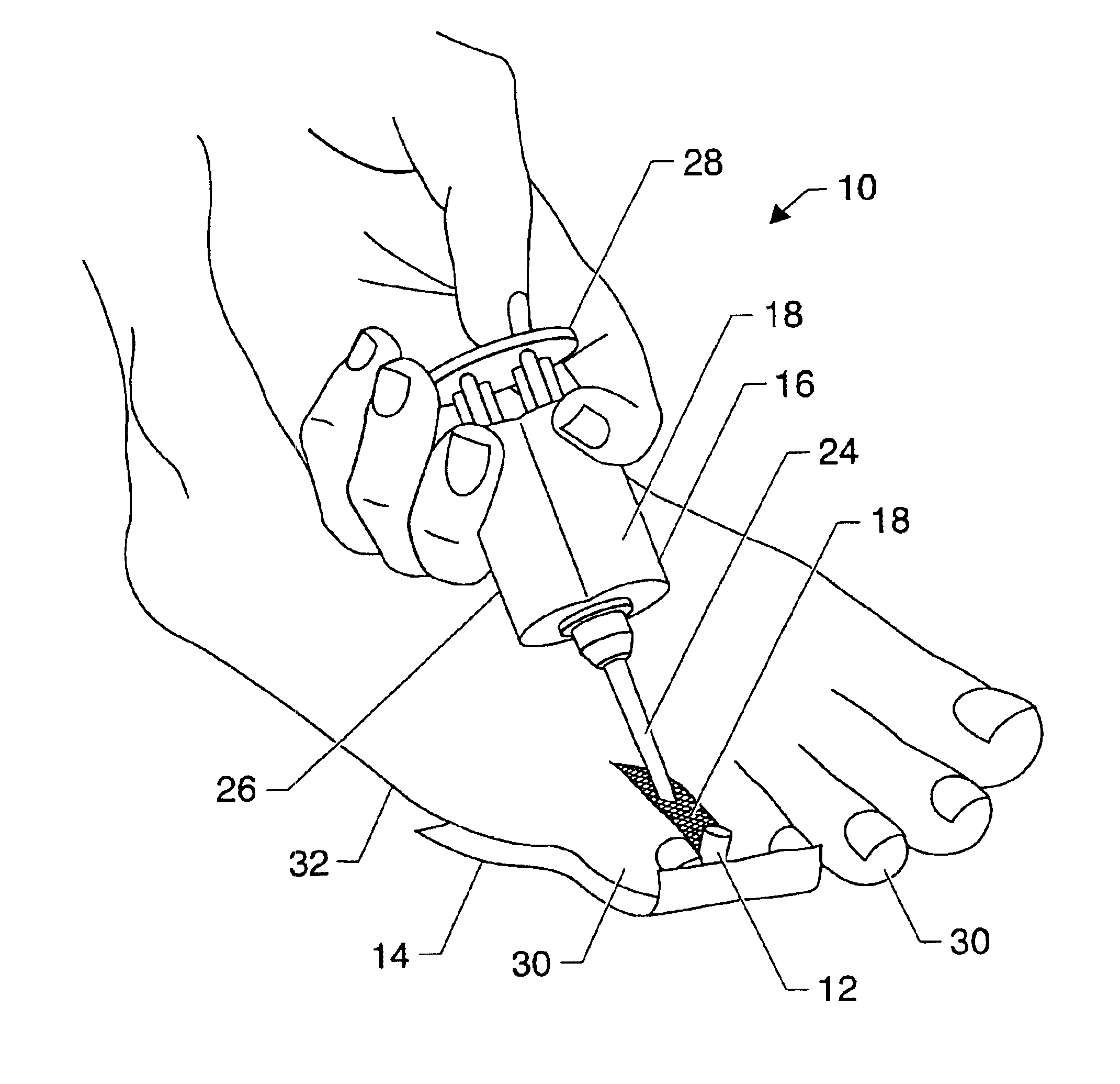 Symptomatic relief for soft corns