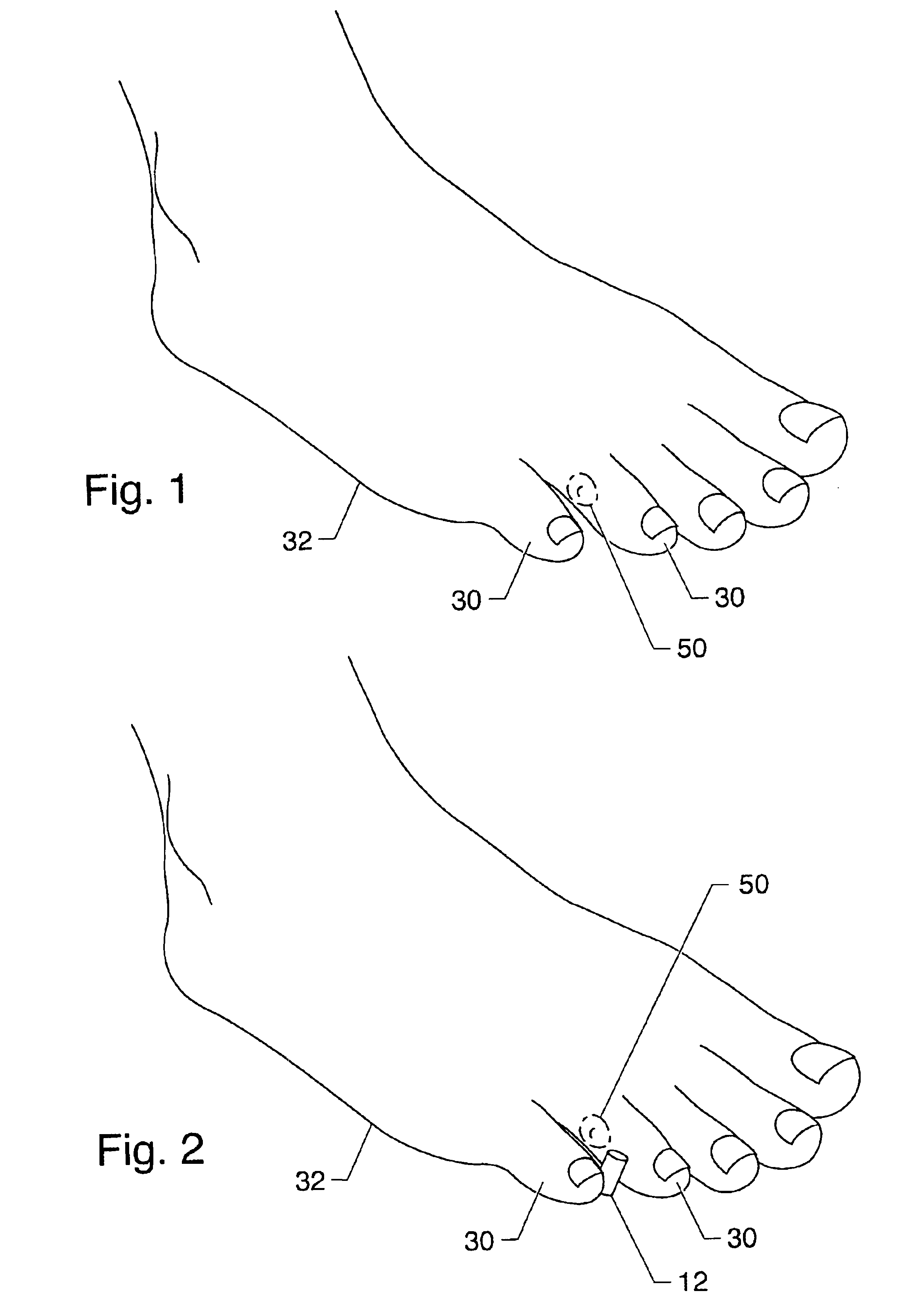 Symptomatic relief for soft corns