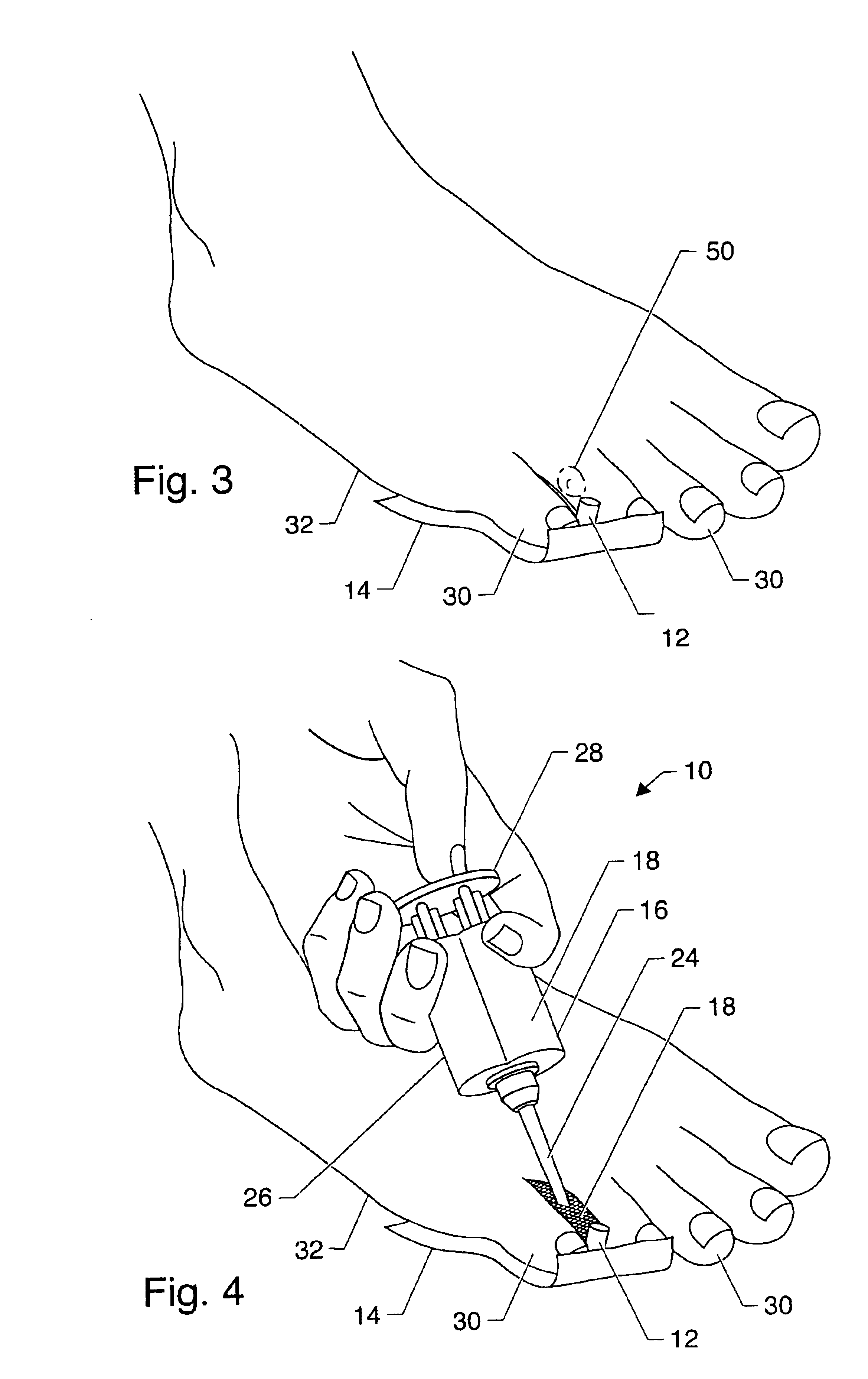 Symptomatic relief for soft corns