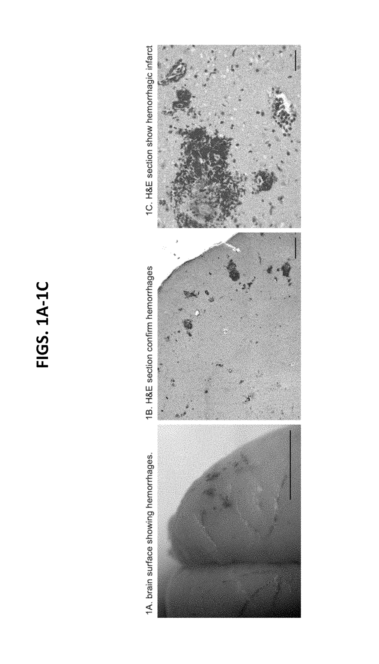 Anti-DEspR monoclonal antibody targeted therapy and imaging for cancer and stroke