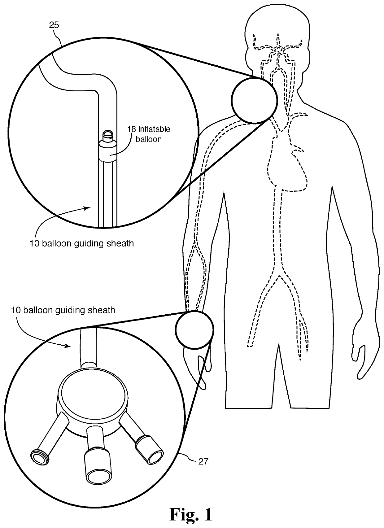 Internal carotid artery thrombectomy devices and methods