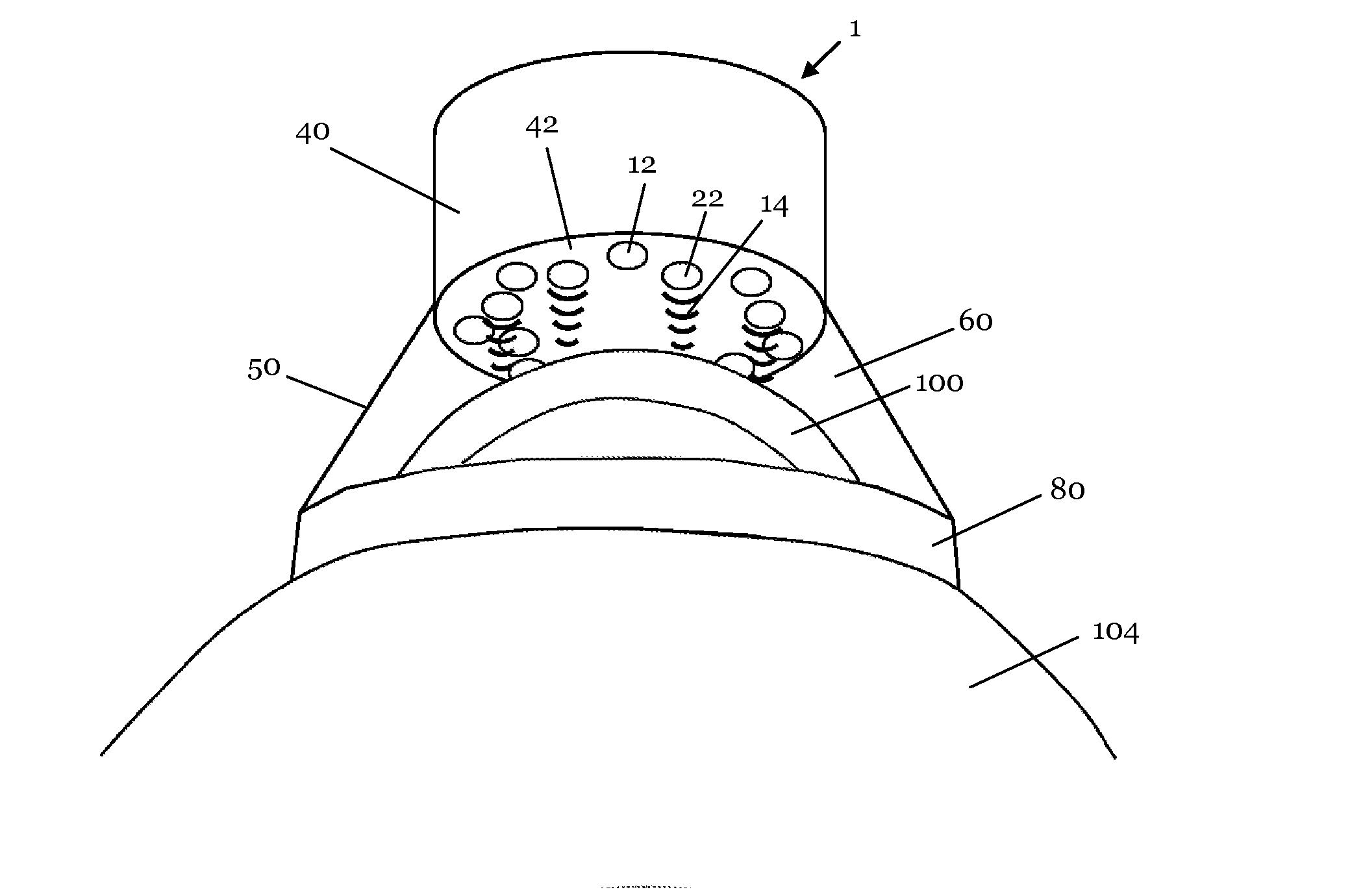 Device and method for performing thermal keratoplasty using high intensity focused ultrasounds