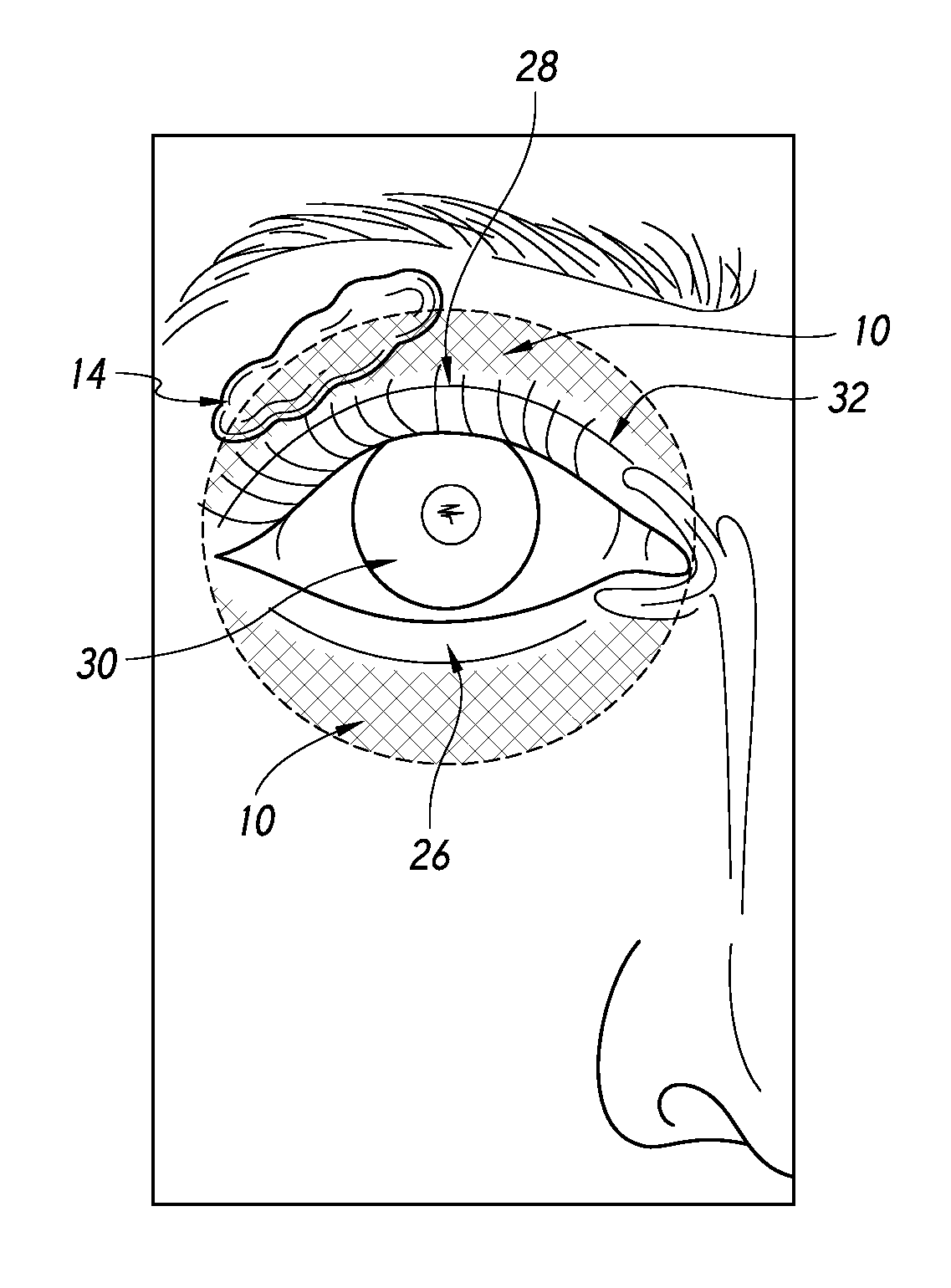 Quantitative peri-orbital application of ophthalmology drugs