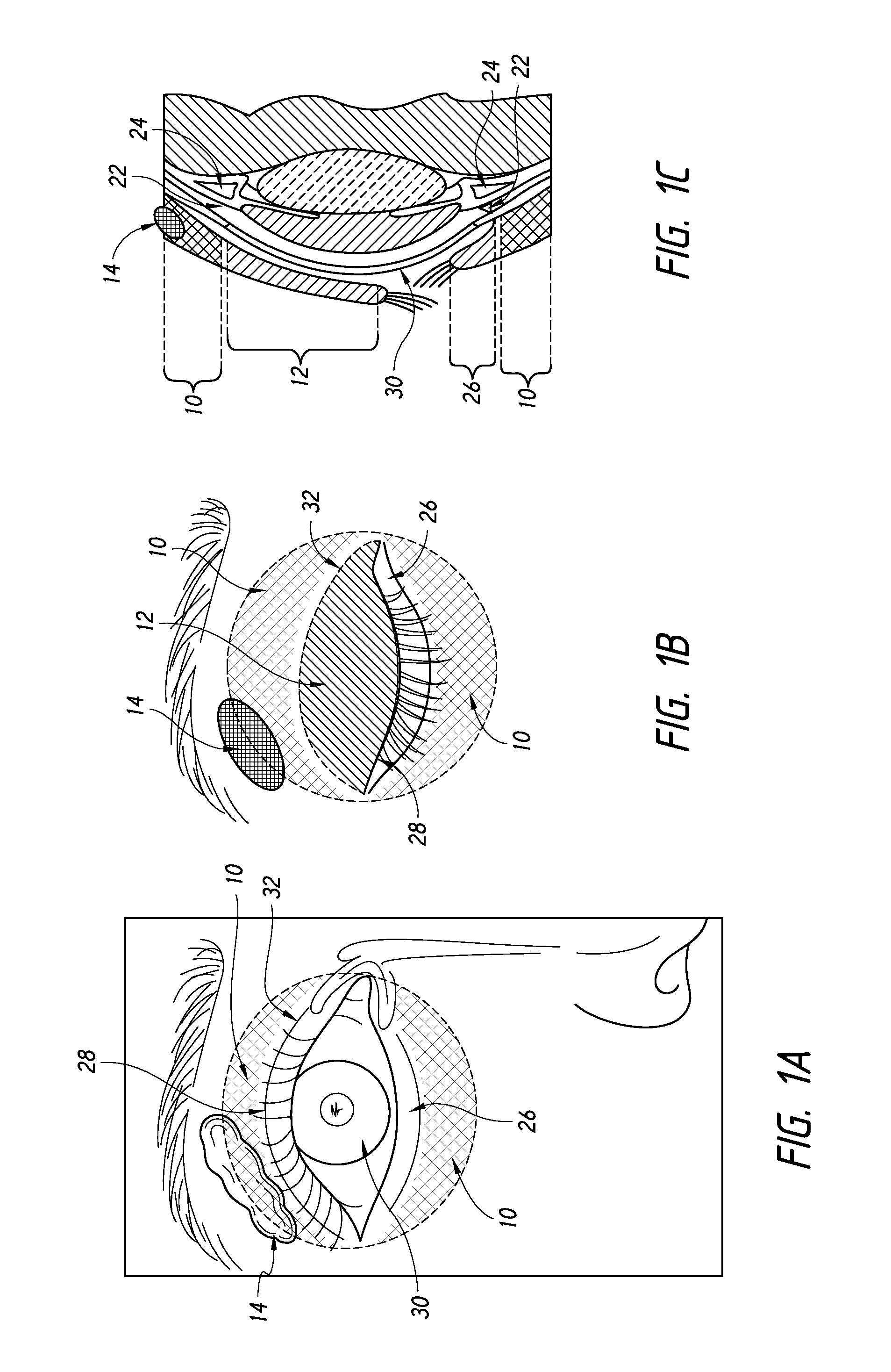 Quantitative peri-orbital application of ophthalmology drugs