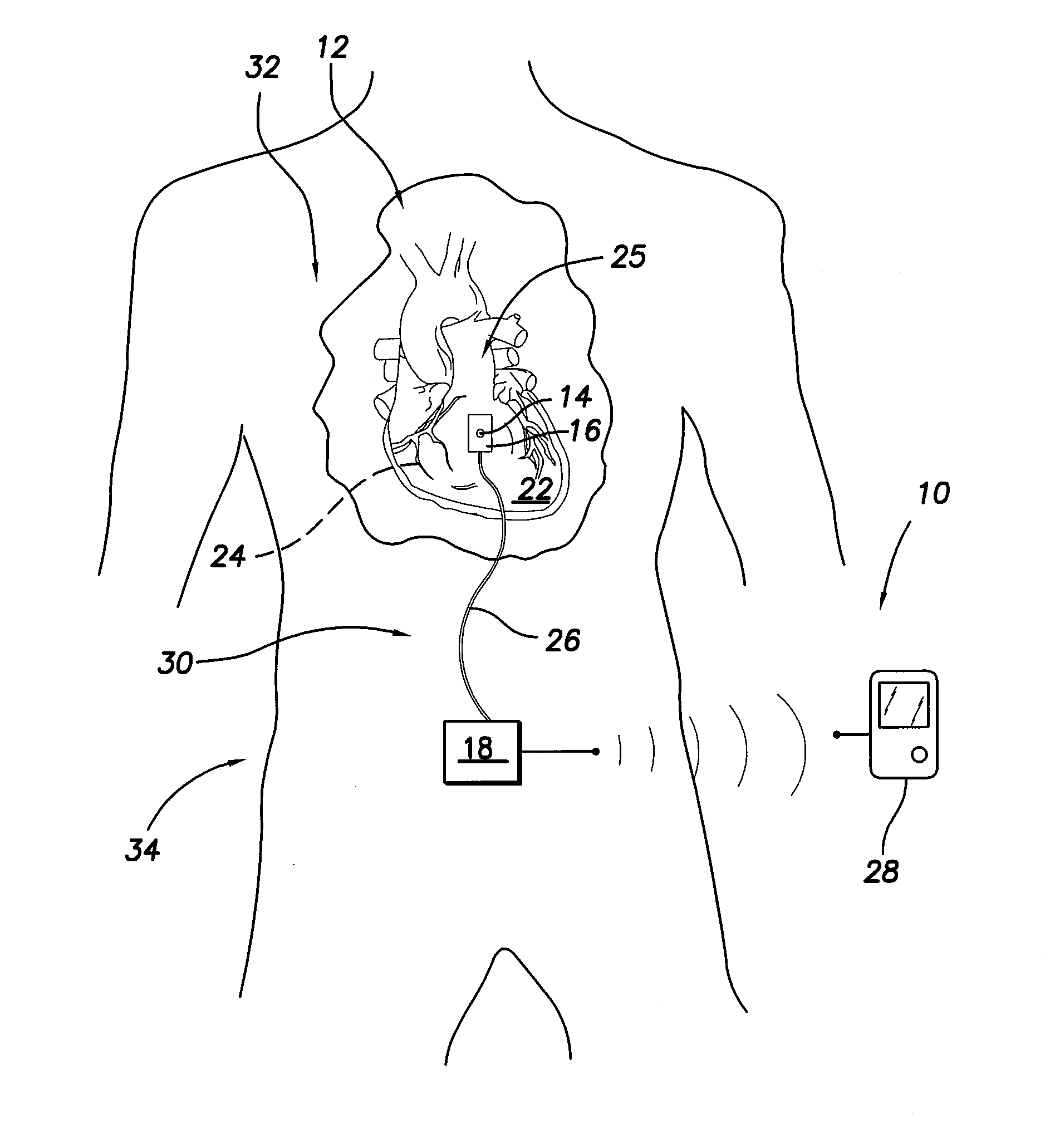 Implantable sensor for measuring physiologic information