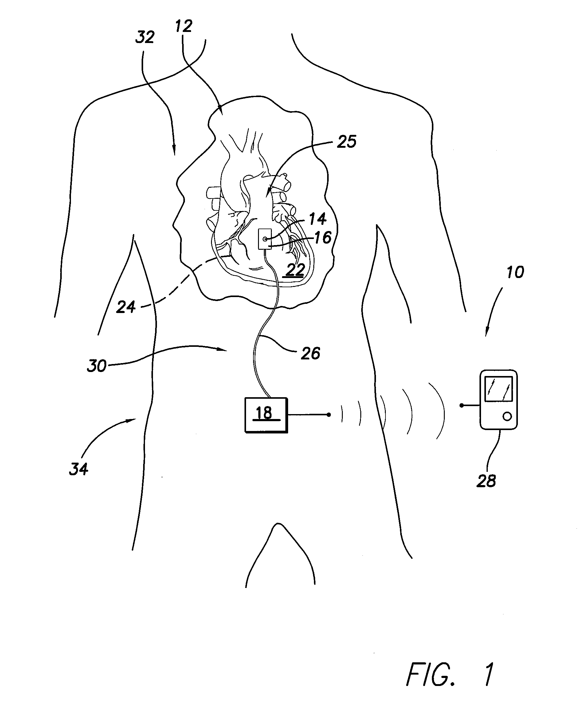 Implantable sensor for measuring physiologic information