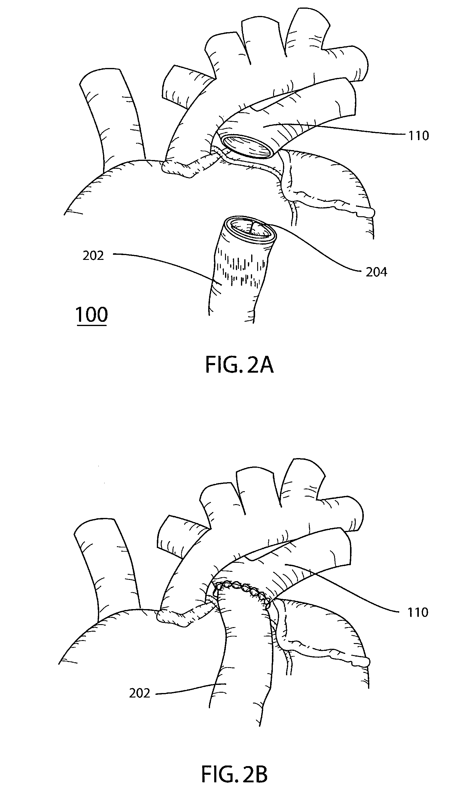 Catheter delivered valve having a barrier to provide an enhanced seal