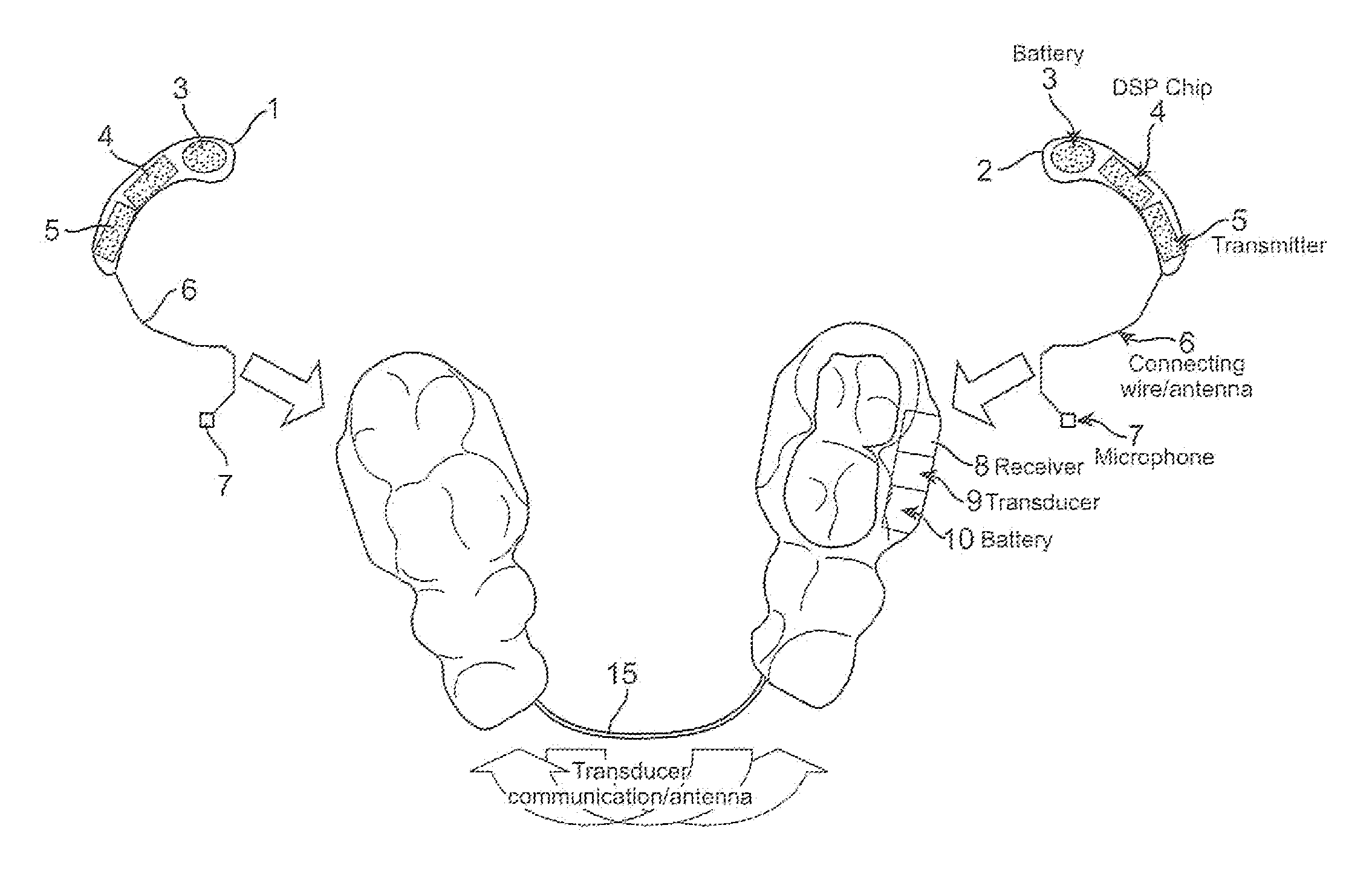 Bone conduction hearing device with open-ear microphone