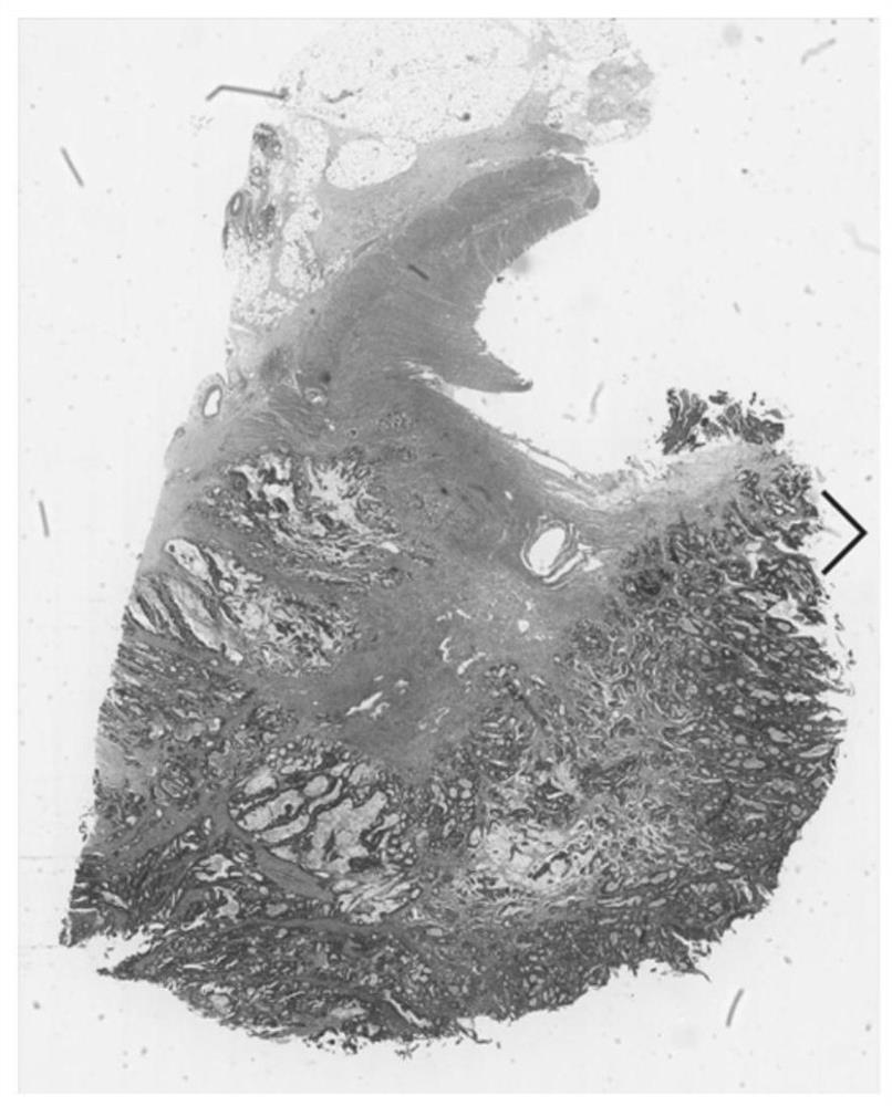 Colorectal cancer pathological image prognosis auxiliary prediction method and system