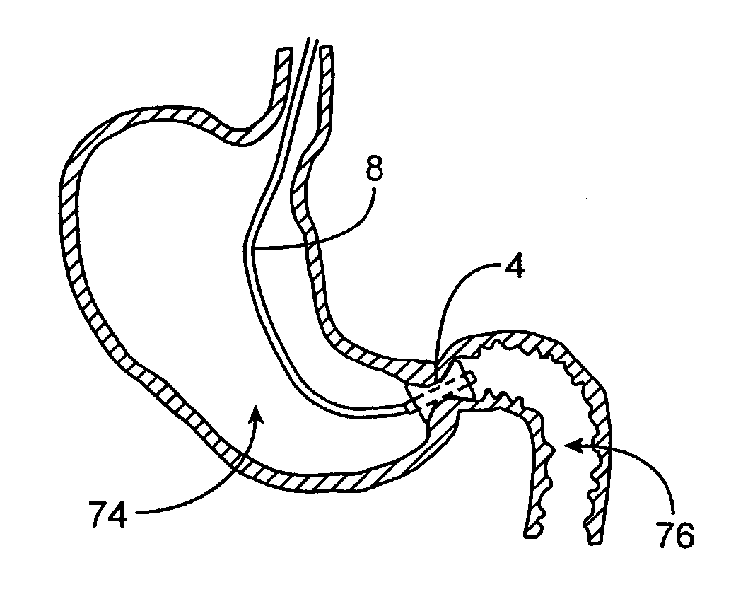 Gastric retaining devices and methods