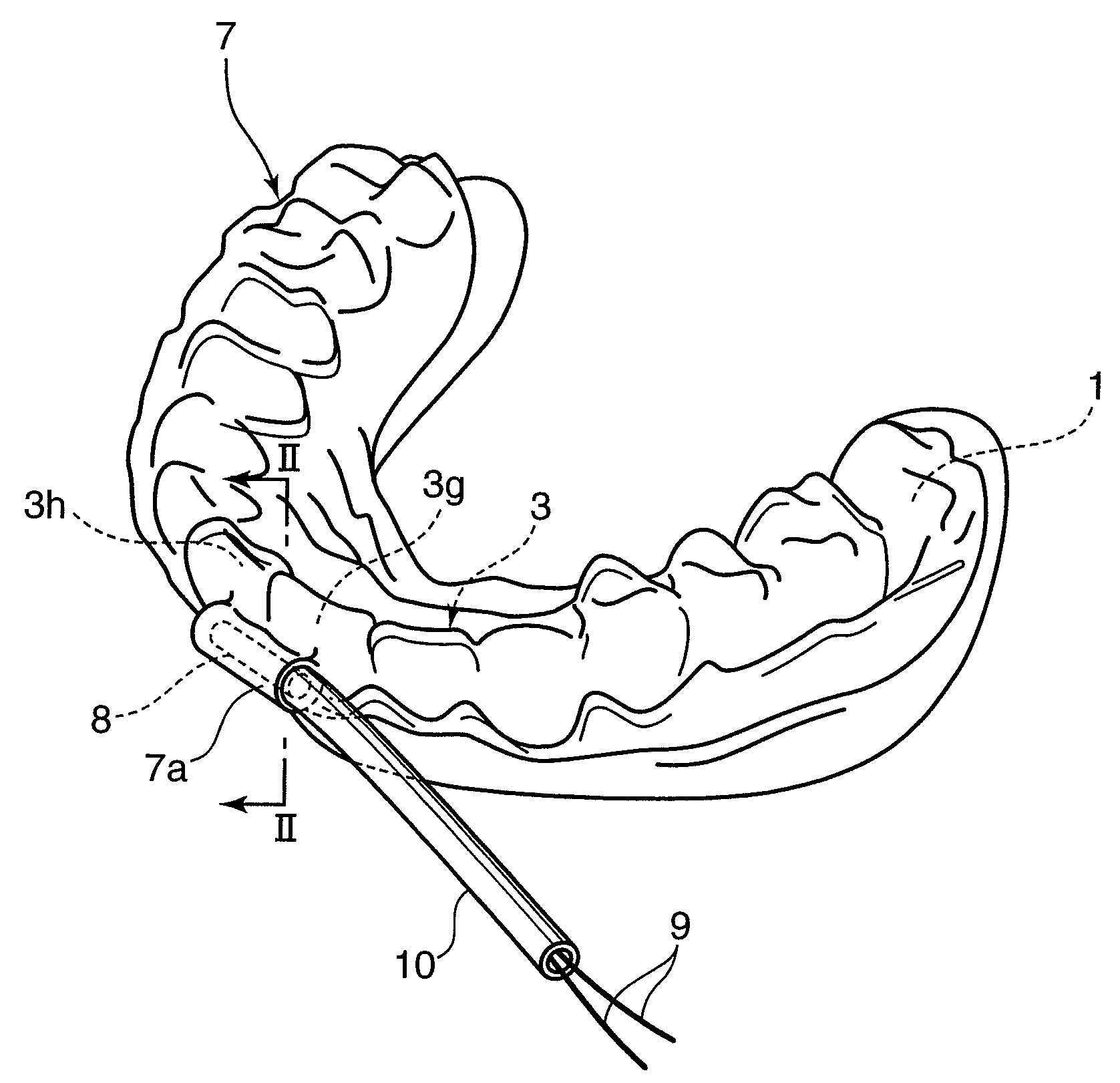 Orthodontic appliance