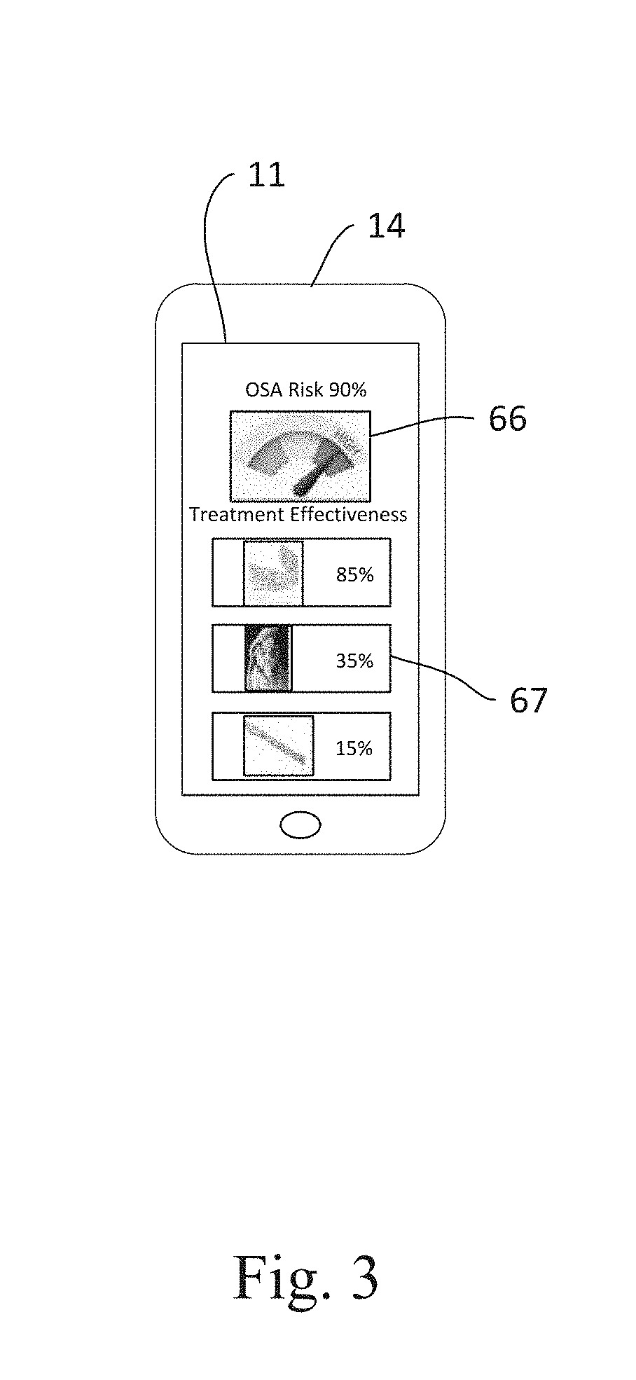 Method and System for Diagnosis and Prediction of Treatment Effectiveness for Sleep Apnea