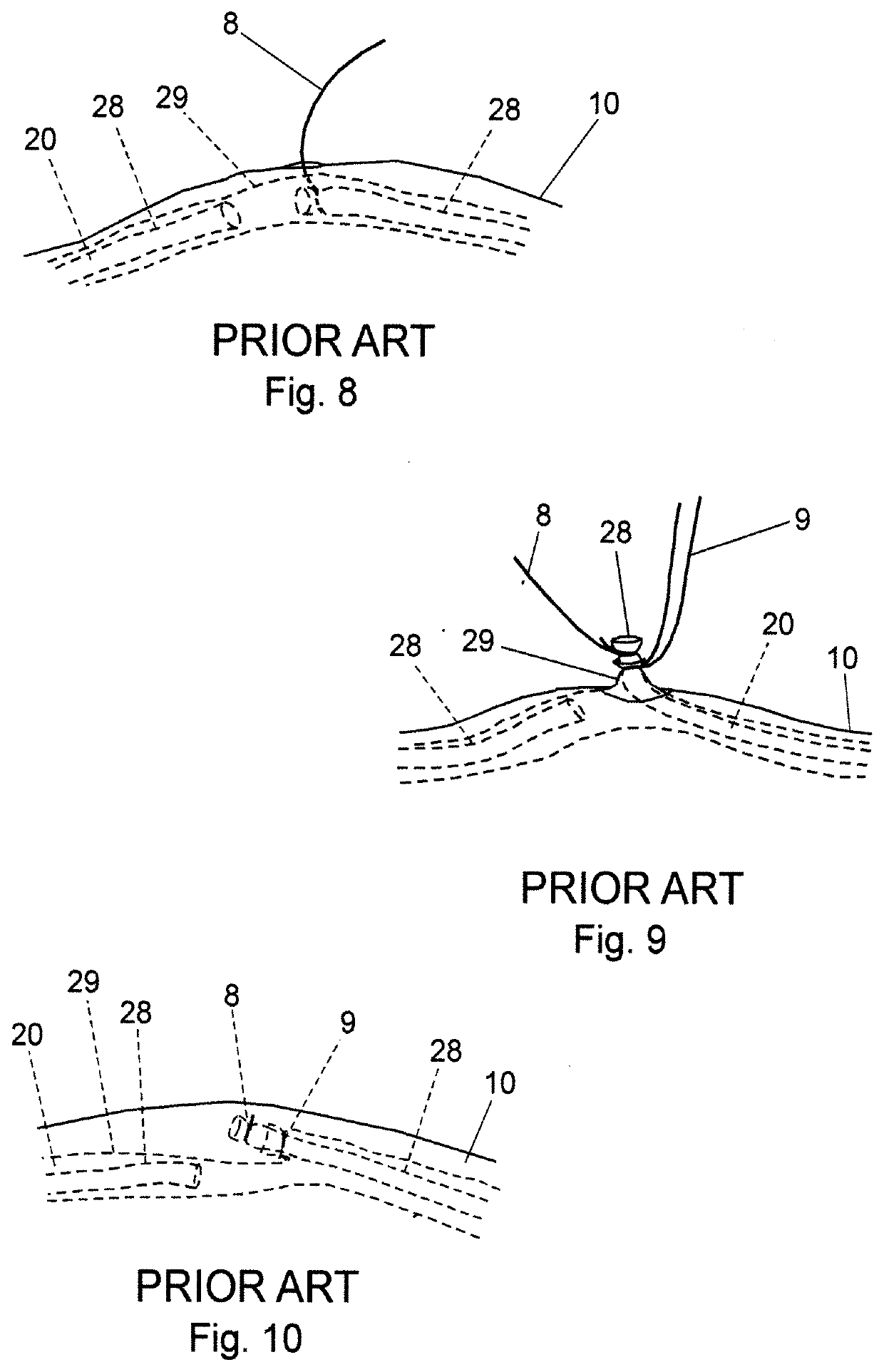 Bipolar coagulating devices and vasectomy kits associated therewith