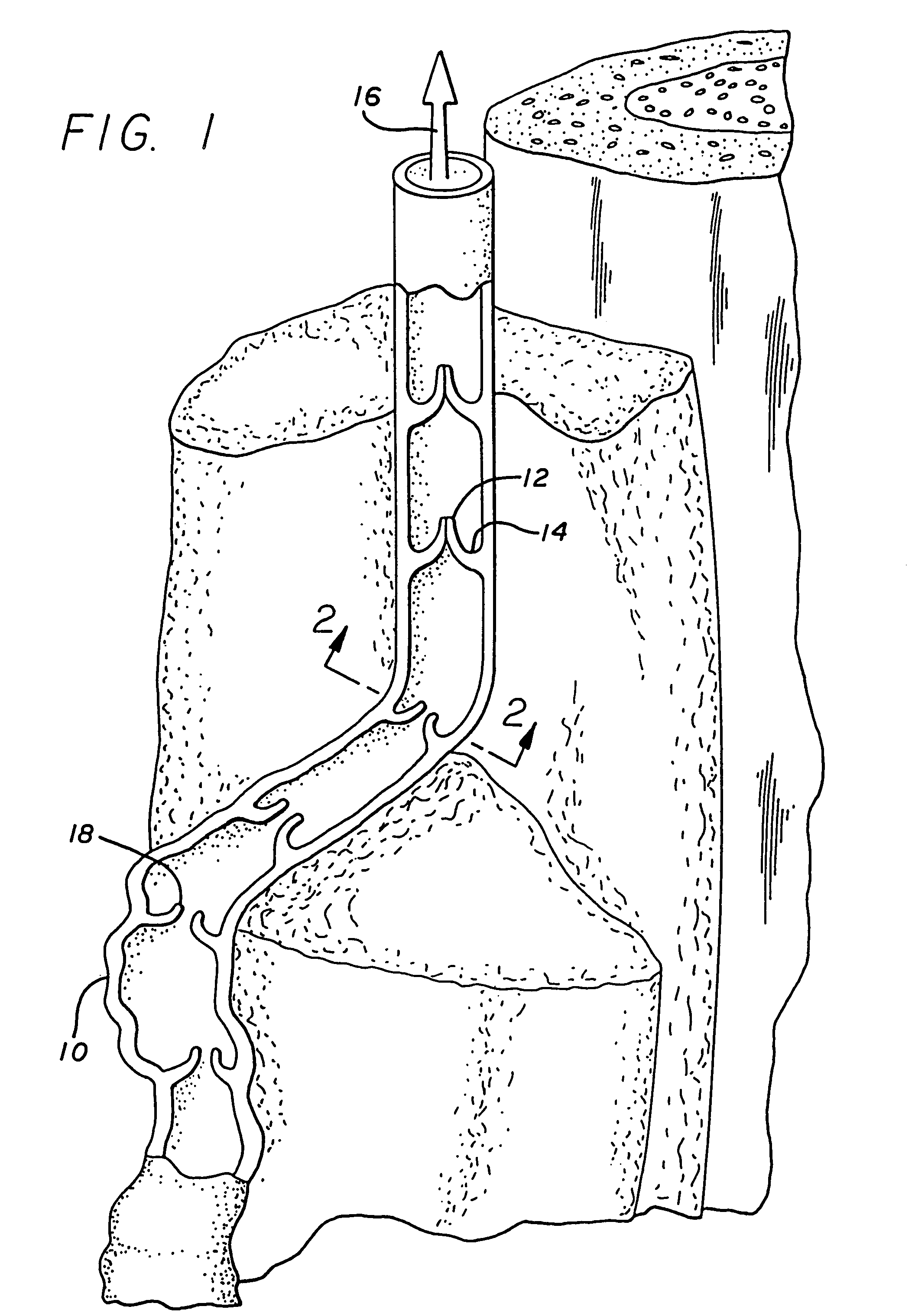 Apparatus for treating venous insufficiency using directionally applied energy