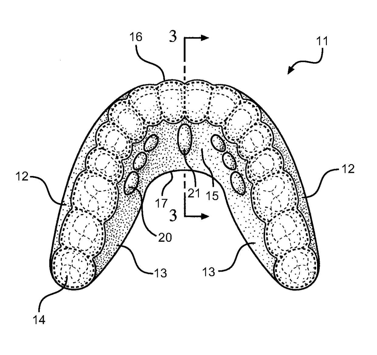 Method and oral appliance for improving air intake and reducing bruxism