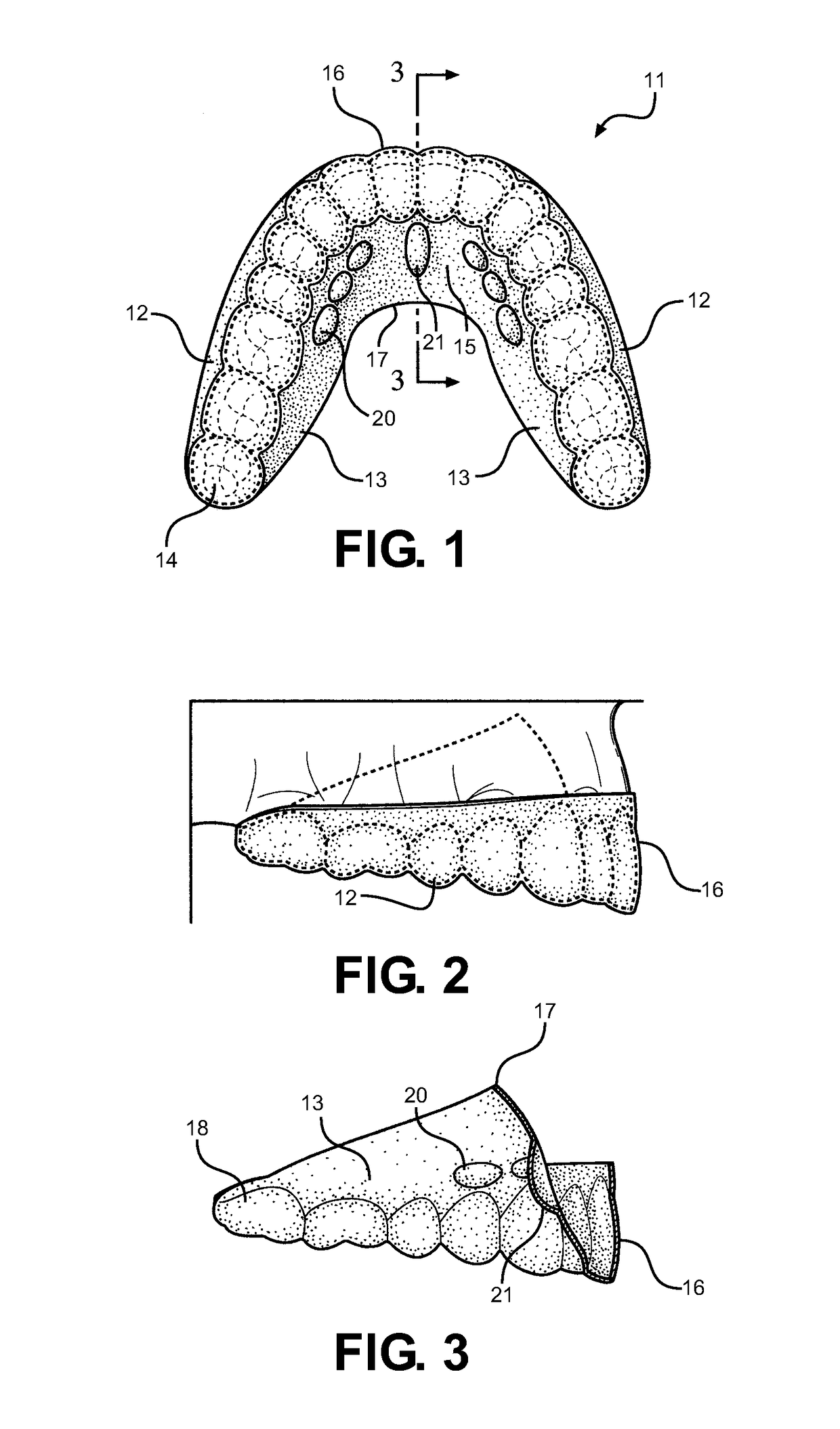 Method and oral appliance for improving air intake and reducing bruxism