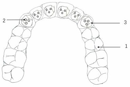 Invisible device for pressing down anterior teeth, rising posterior teeth and opening occlusion in invisible correction process