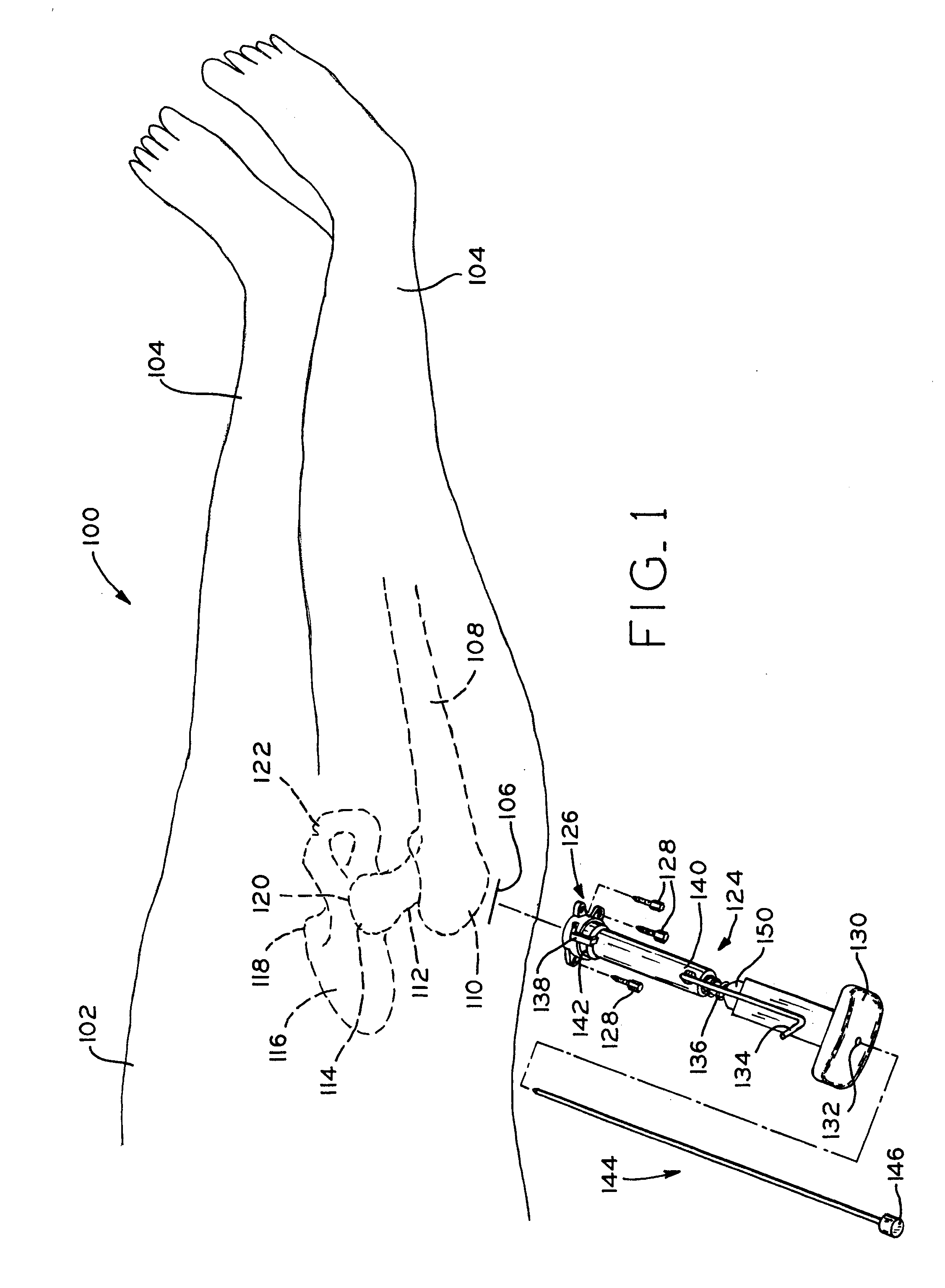 Method and apparatus for reducing femoral fractures