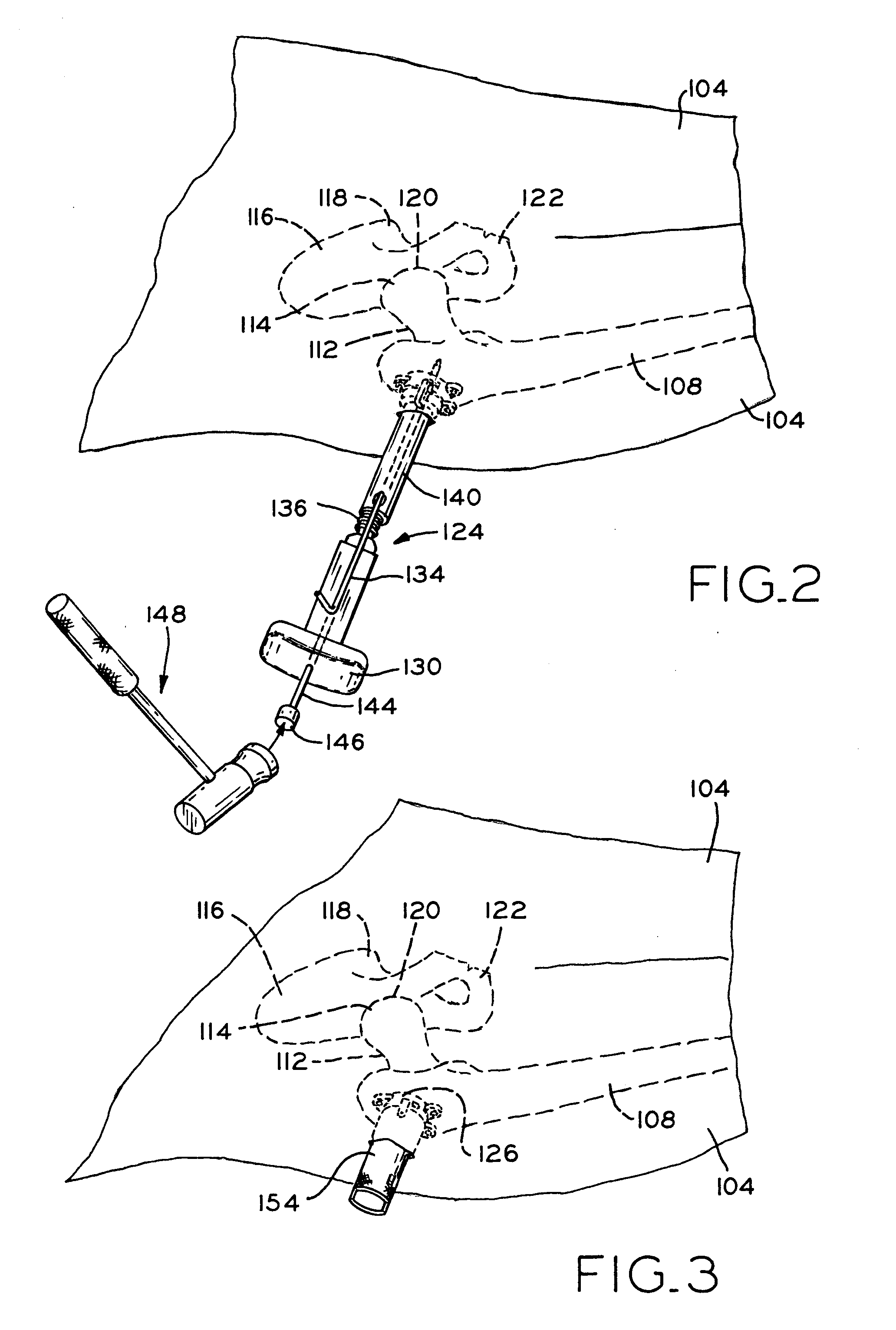 Method and apparatus for reducing femoral fractures