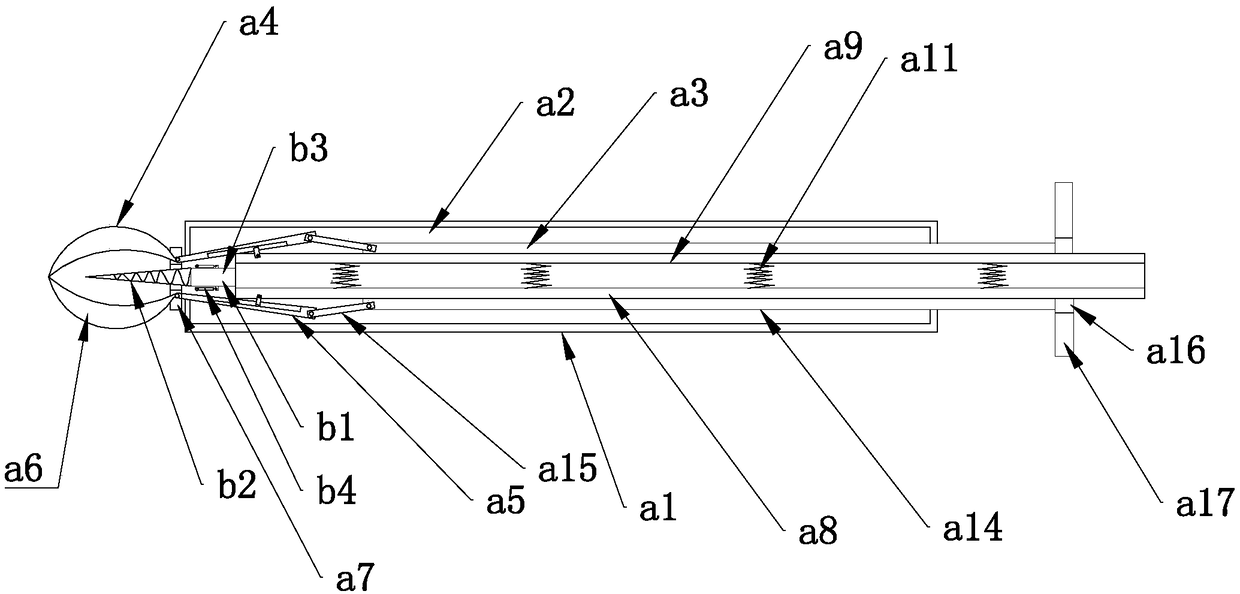 Intrahepatic stone extractor