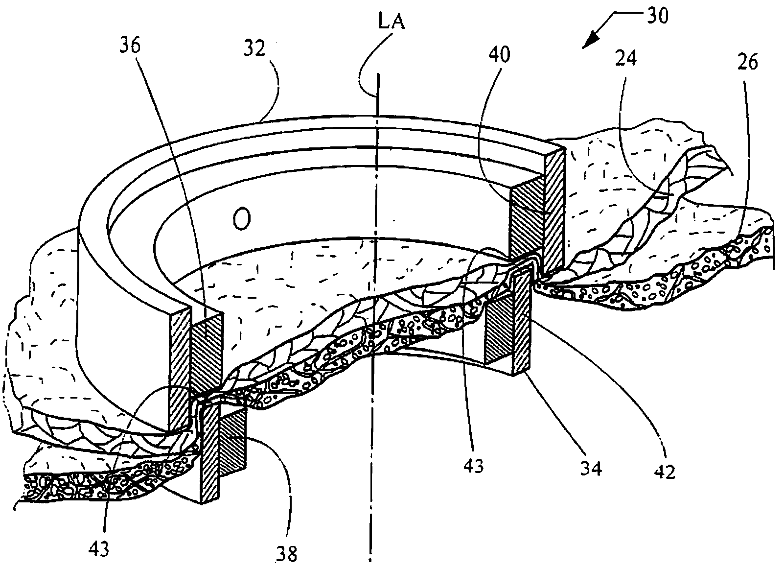 Ring magnets for surgical procedures