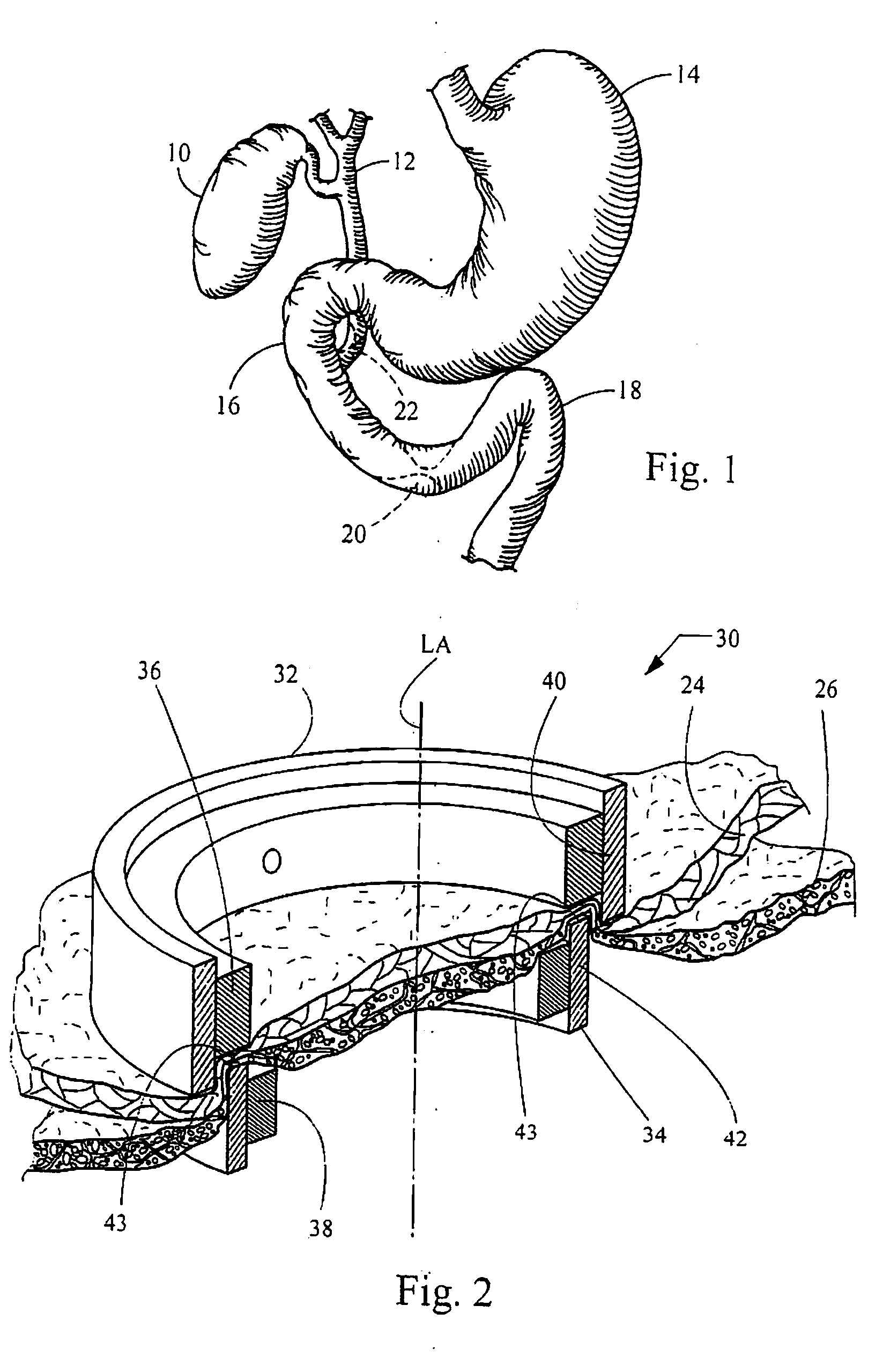 Ring magnets for surgical procedures