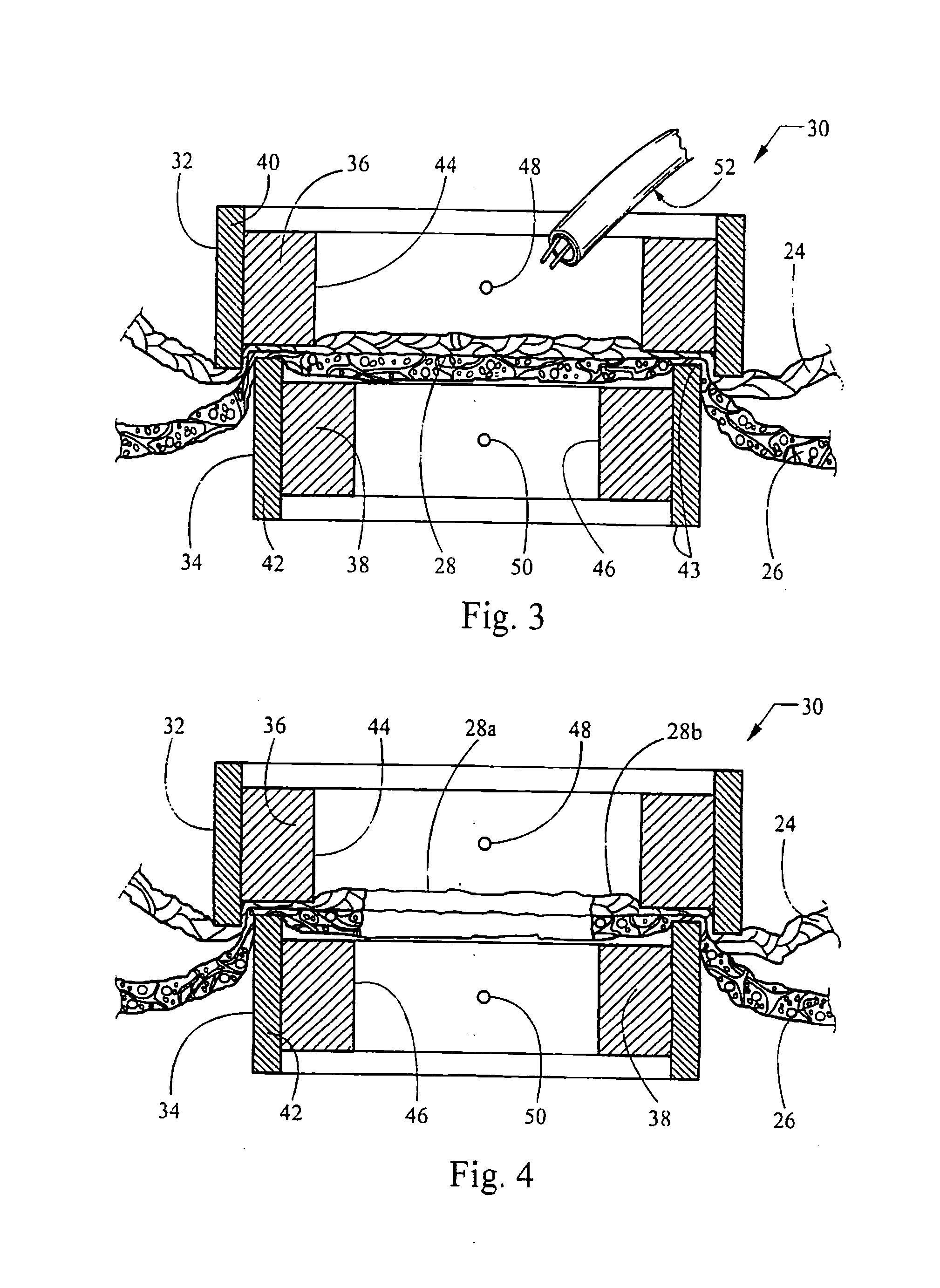 Ring magnets for surgical procedures