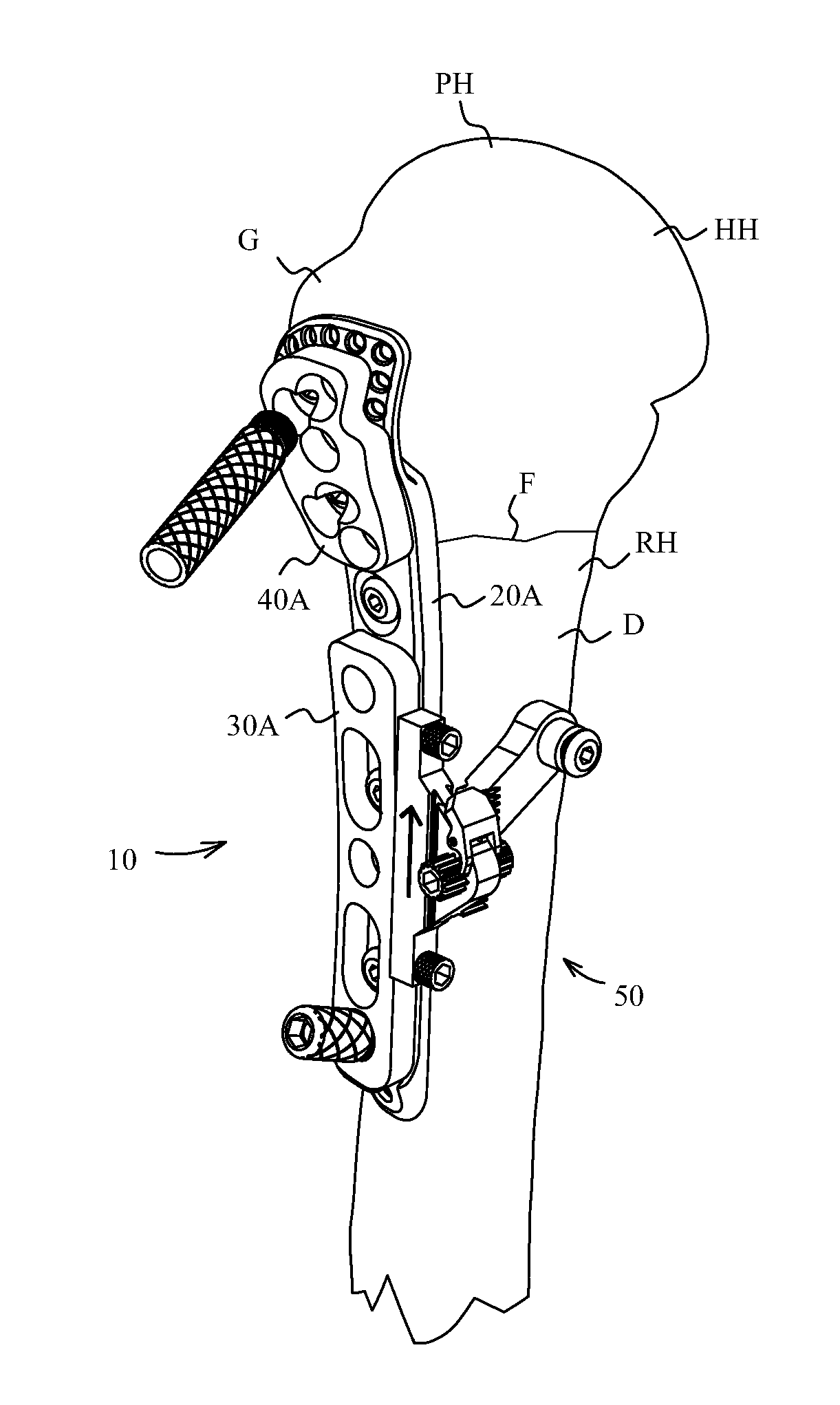 Proximal humerus fracture repair plate and system