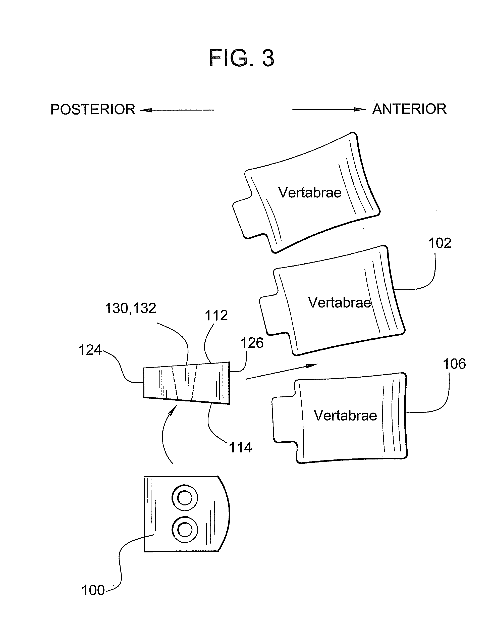 Invertebral spinal implant and method of making the same