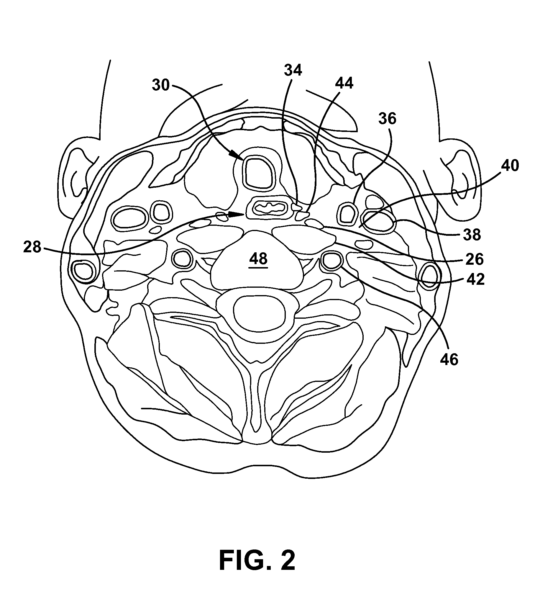 Ultrasound-guided delivery of a therapy delivery device to a nerve target