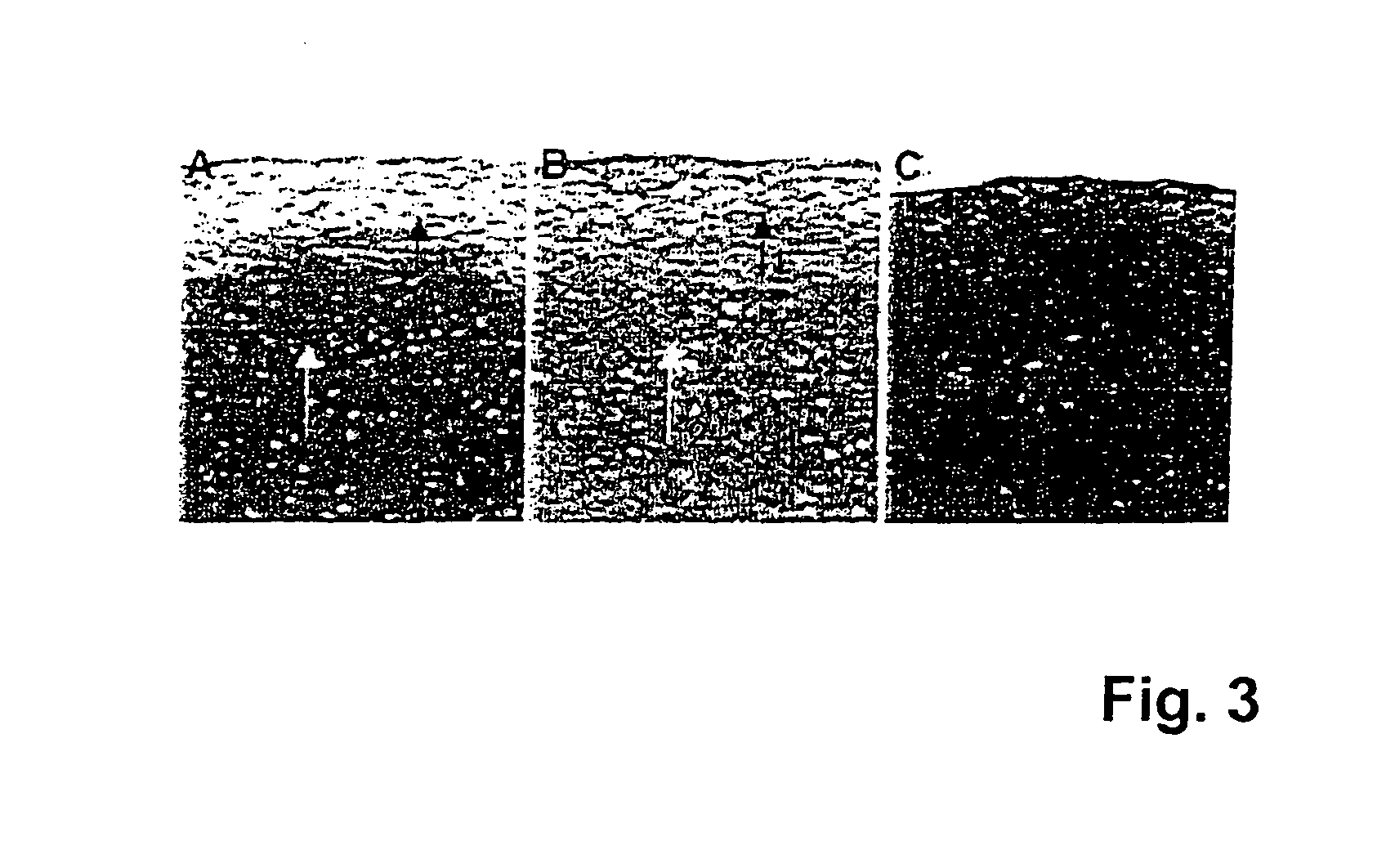 Implant for repairing a cartilage defect