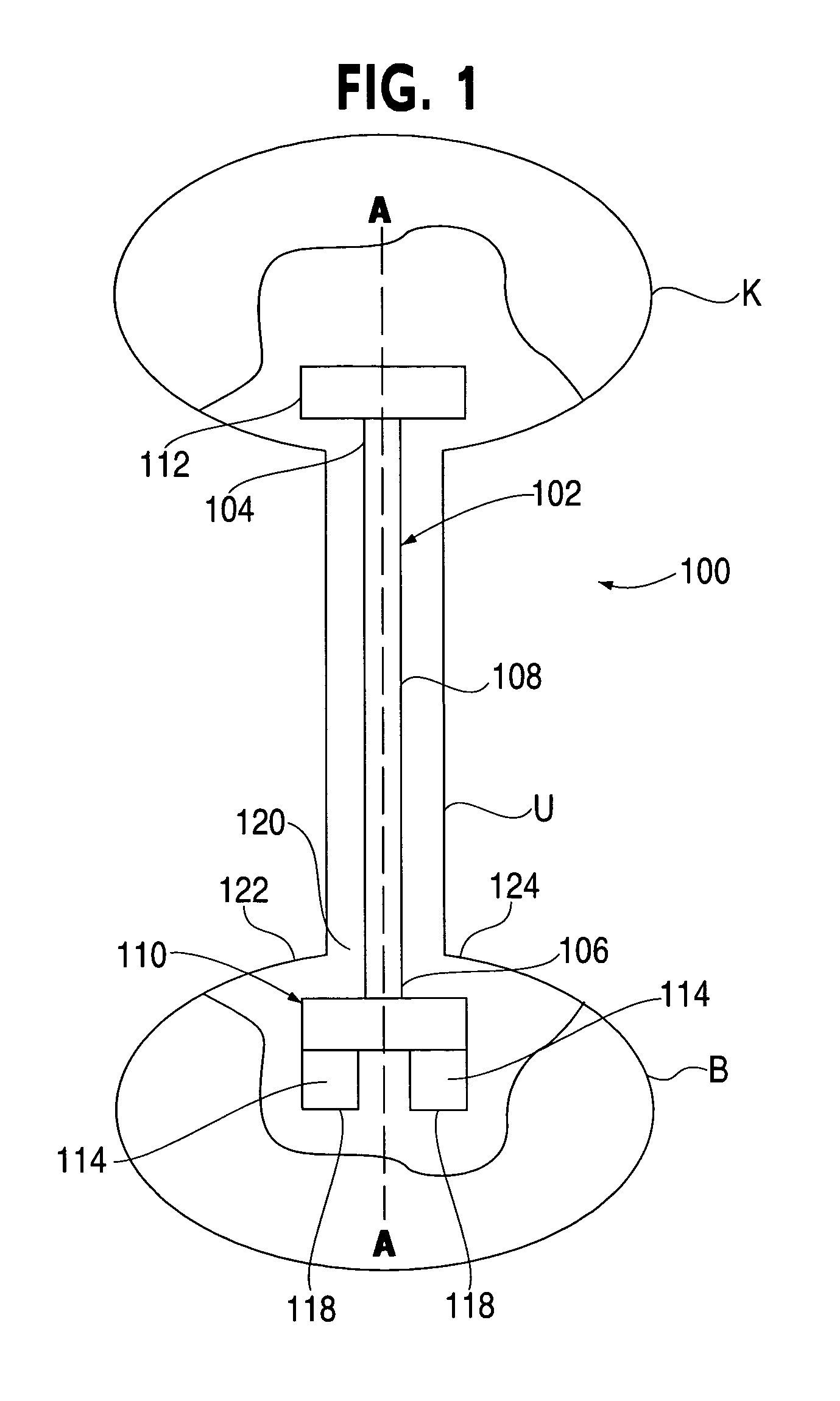 Ureteral stent with conforming retention structure