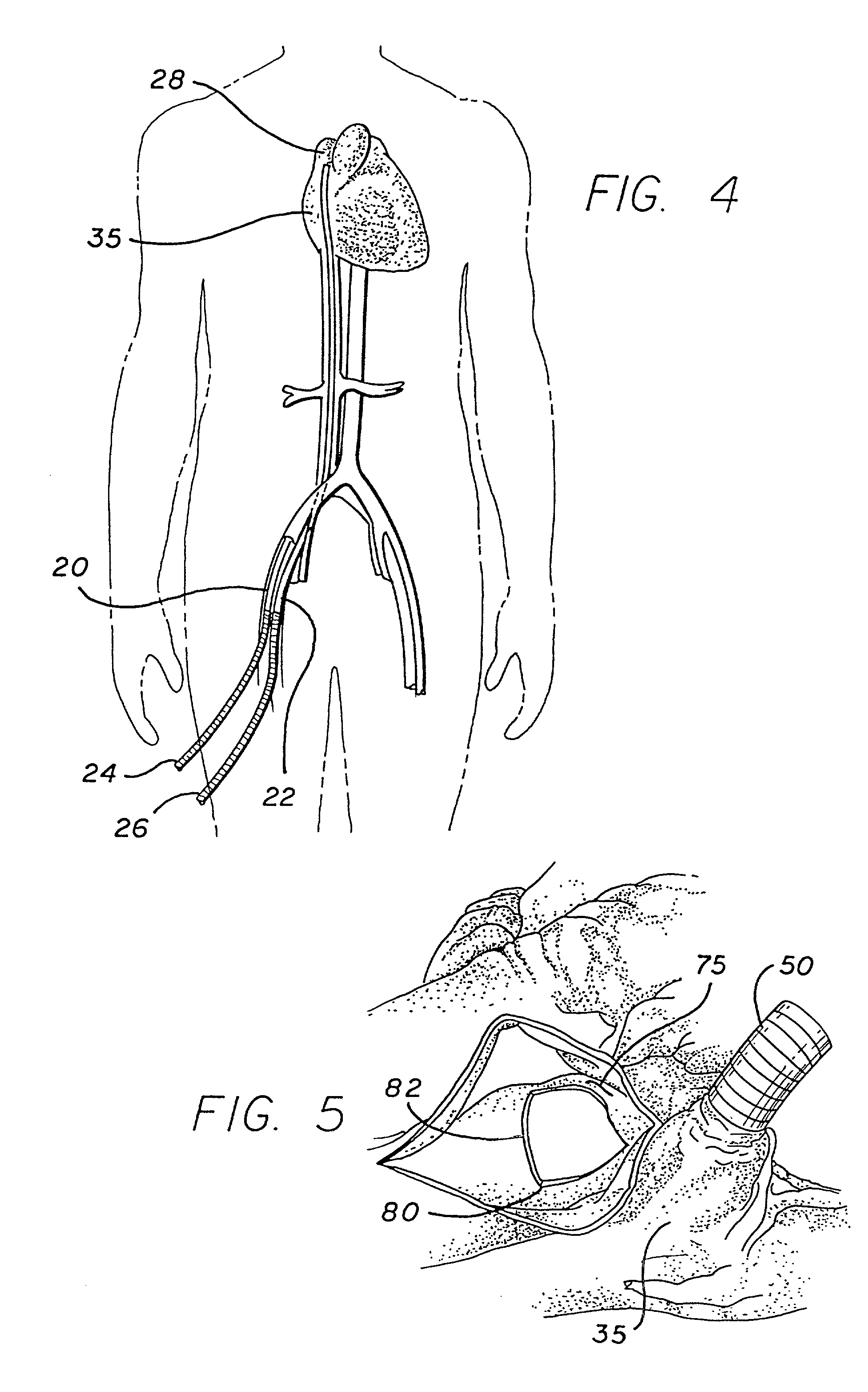 Minimally invasive cardiac surgery procedure