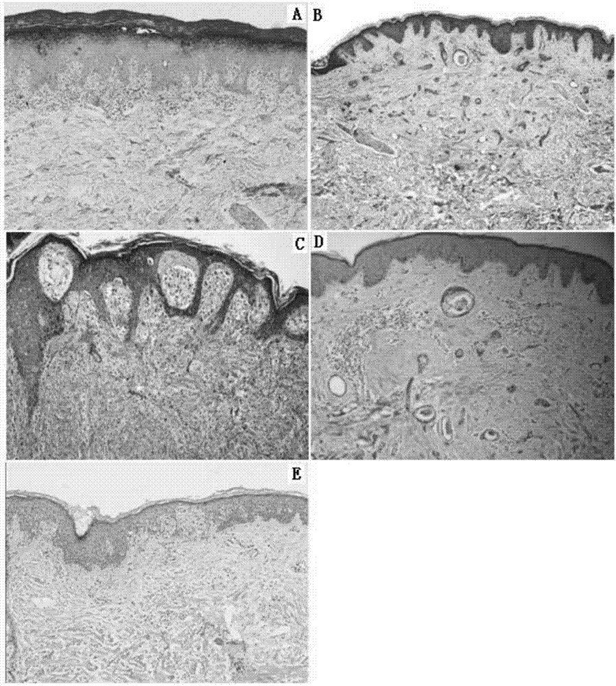 Application of sinomenine in preparation of drug for treating photosensitive dermatitis