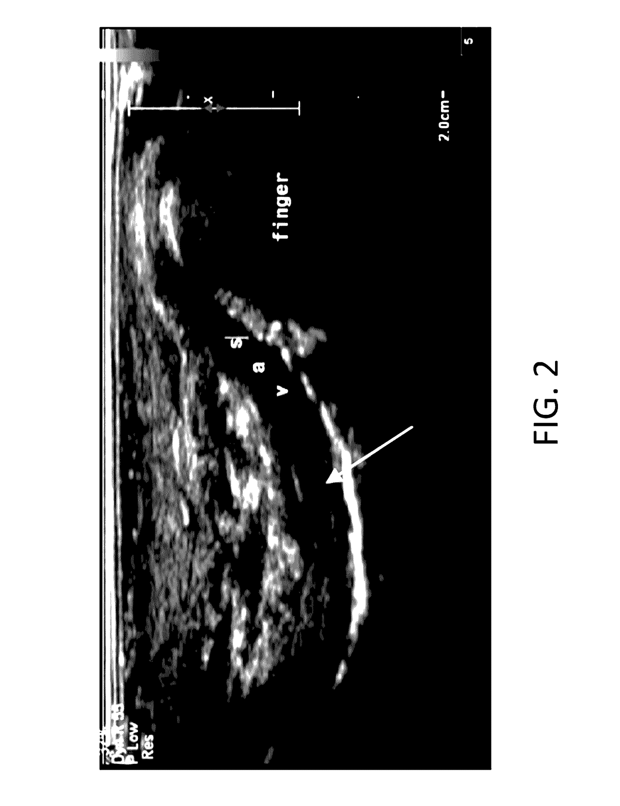 Methods for vas-occlusive contraception and reversal thereof