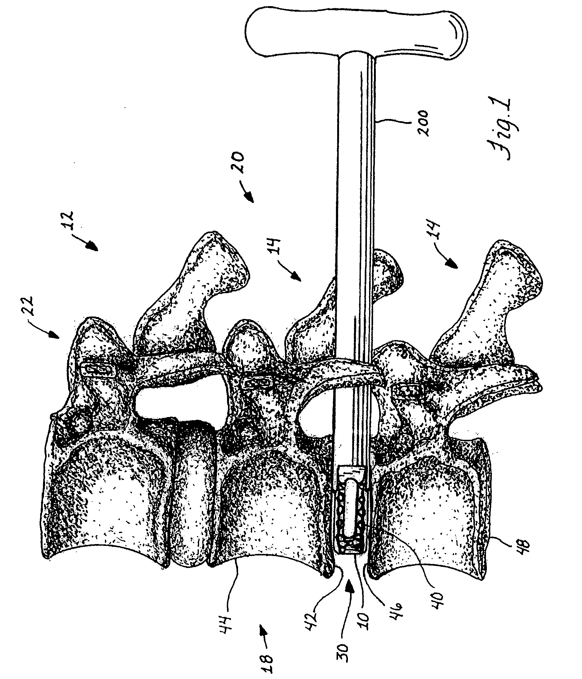 Spinal stabilization device and methods