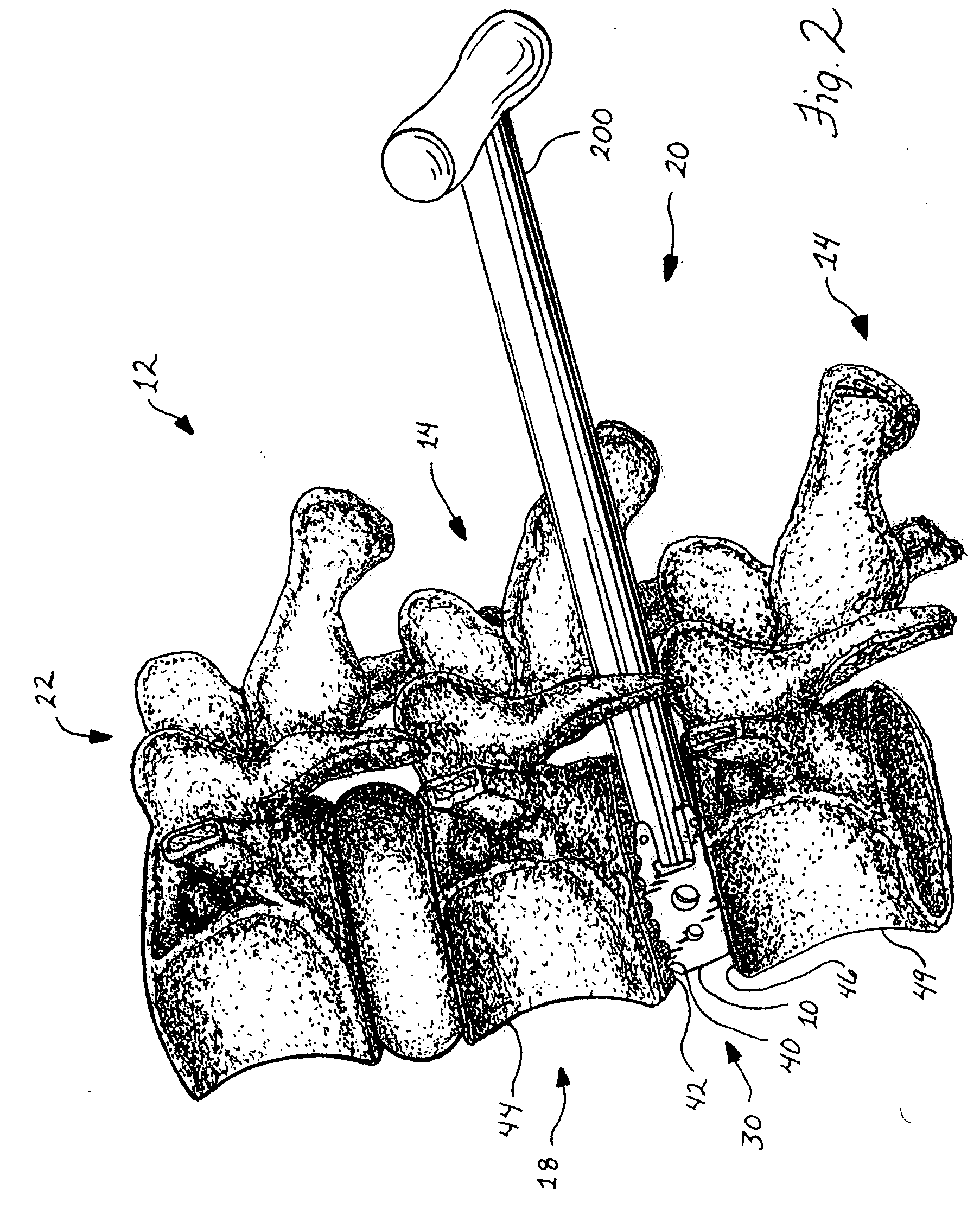 Spinal stabilization device and methods