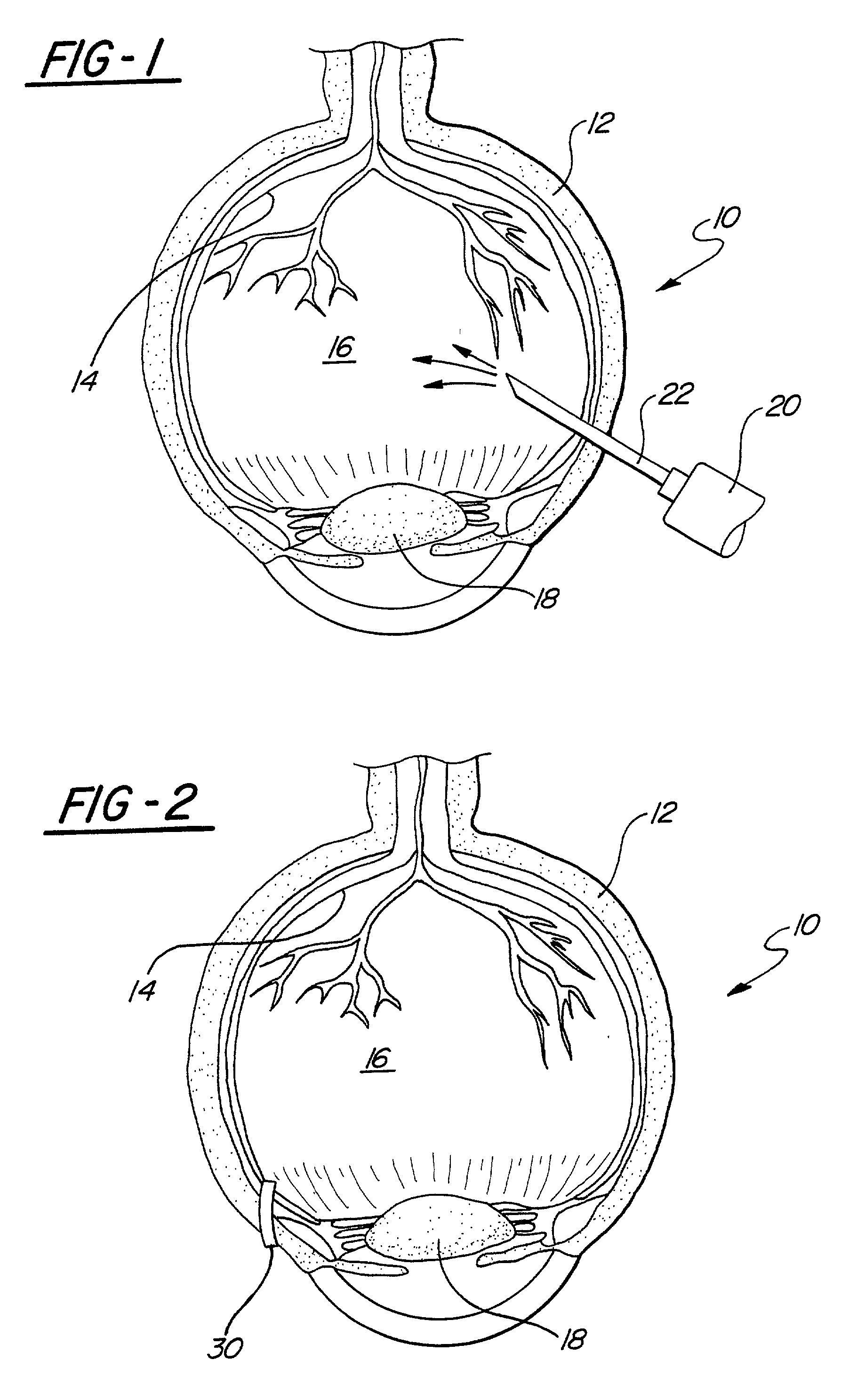 Method for creating a separation of posterior cortical vitreous from the retina of the eye