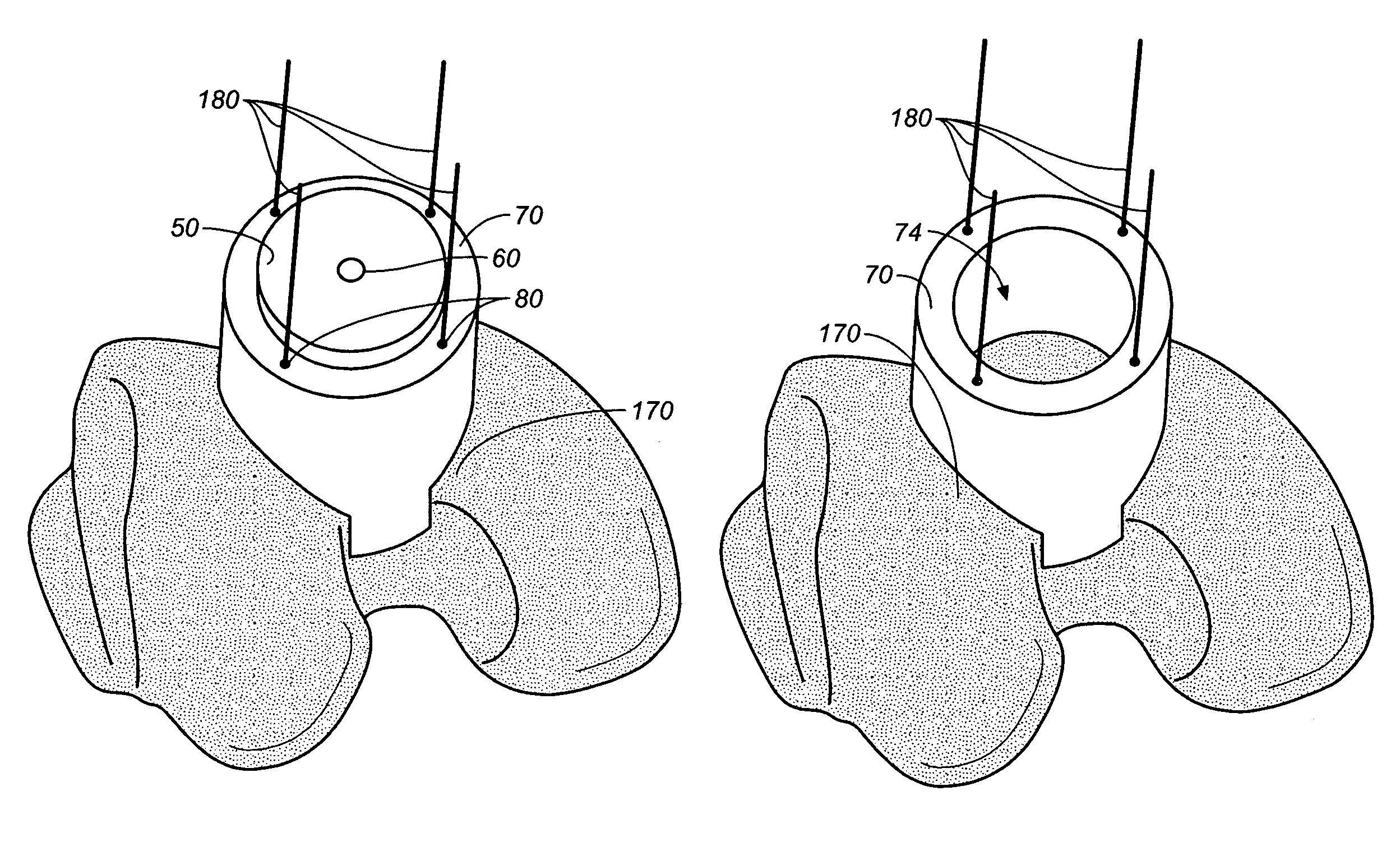 Device and method for allograft and tissue engineered osteochondral graft surface matching, preparation, and implantation