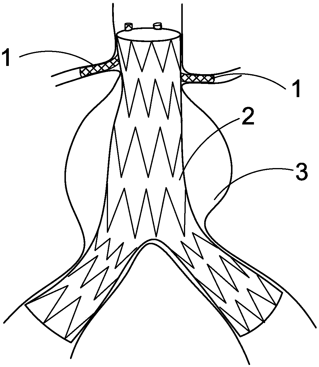 Covered stent