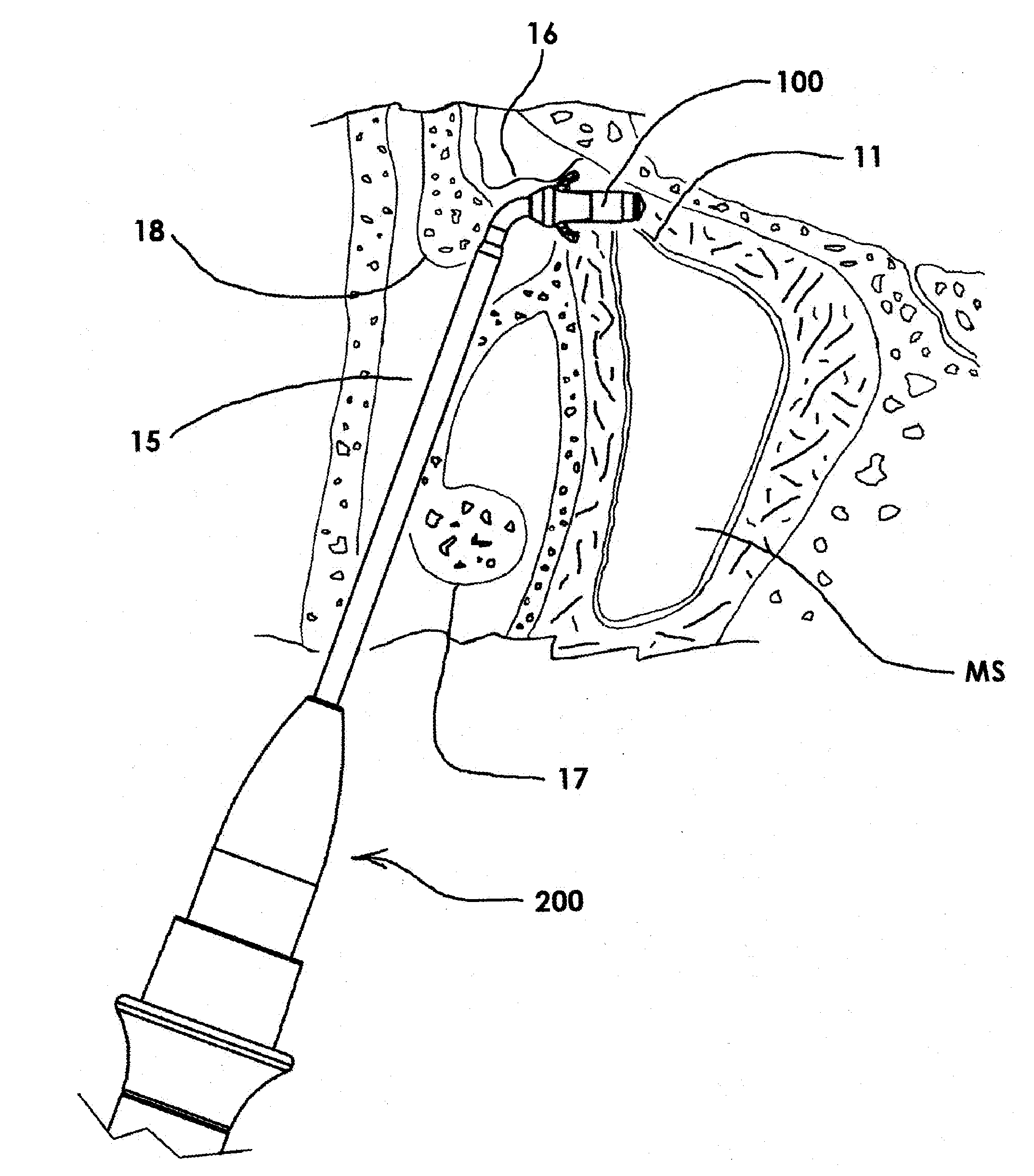 Devices and Methods for Dilating a Paranasal Sinus Opening and for Treating Sinusitis