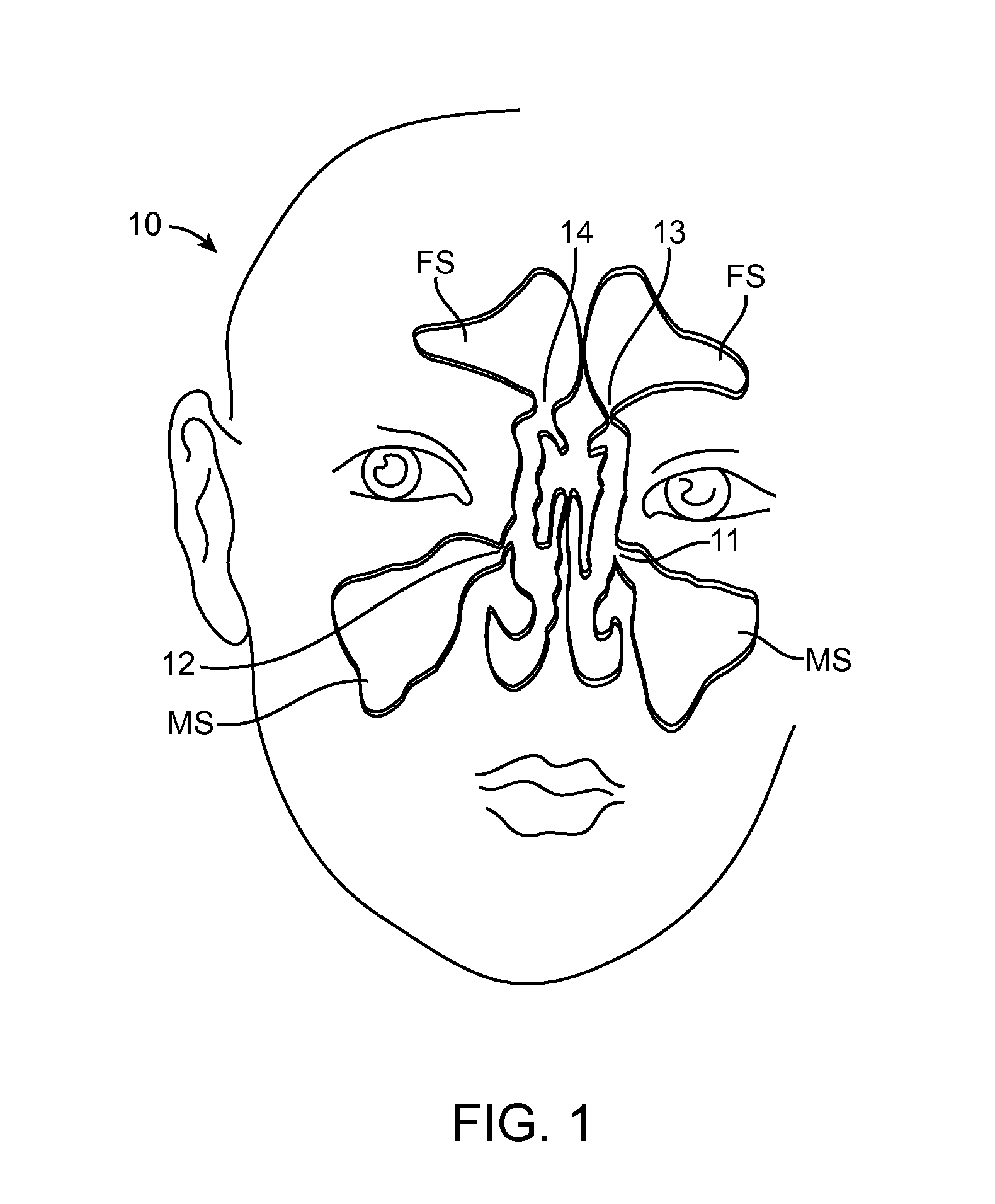 Devices and Methods for Dilating a Paranasal Sinus Opening and for Treating Sinusitis