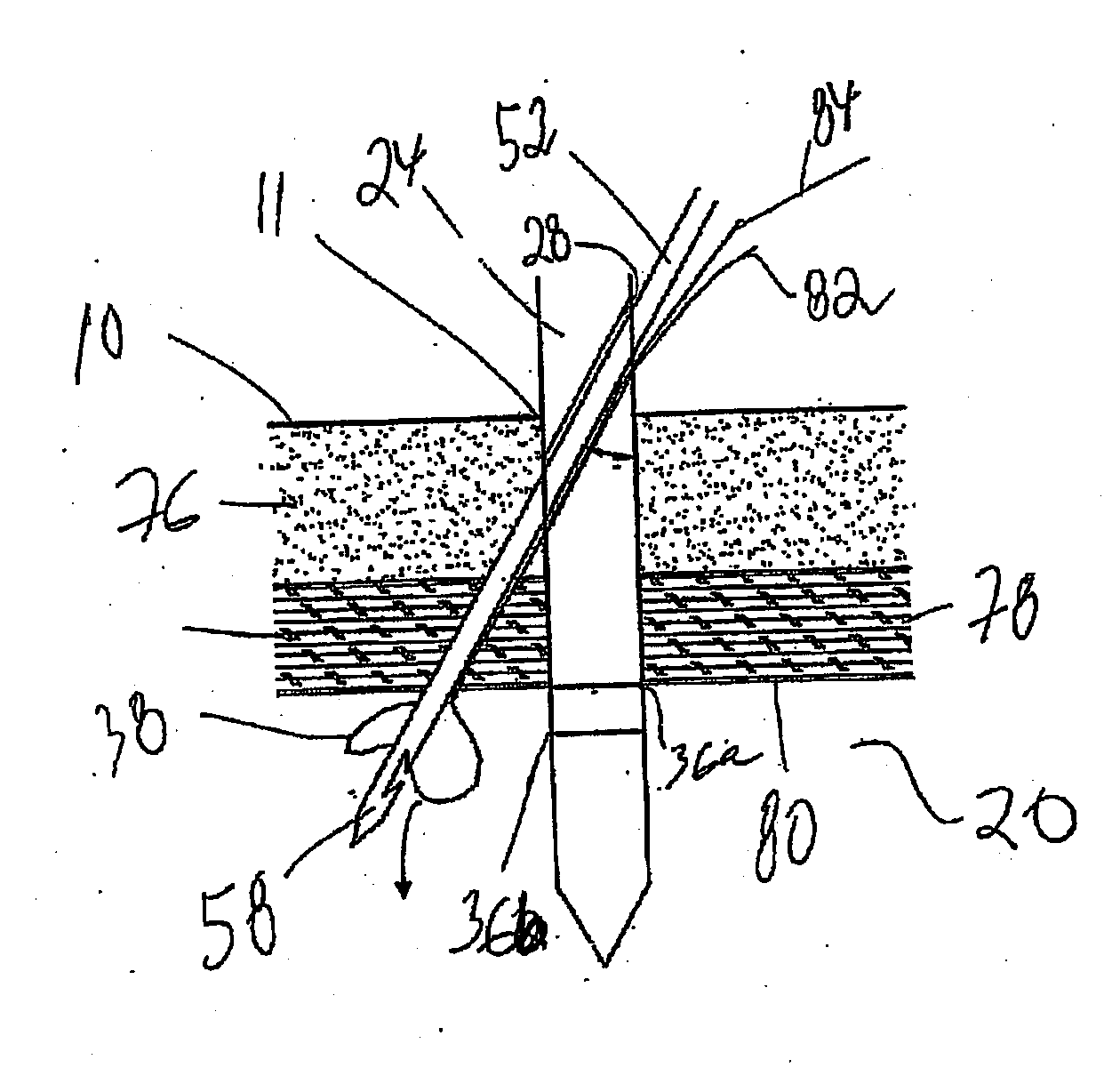 Apparatus and method for laparoscopic port site suture