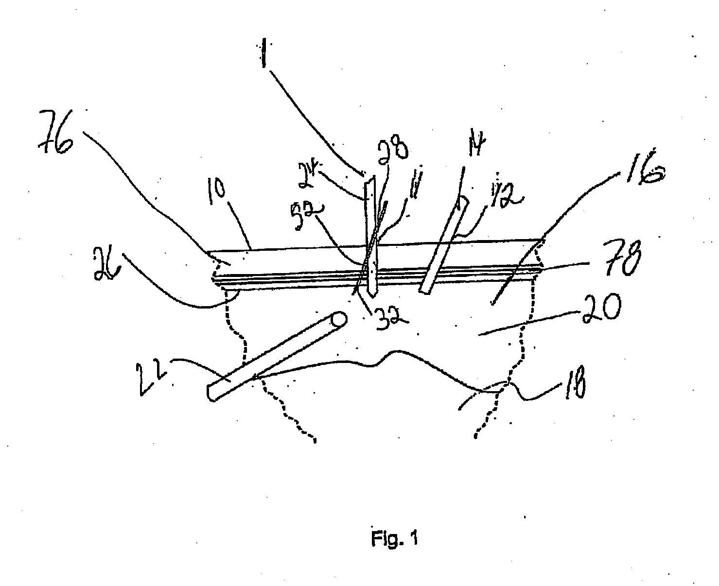 Apparatus and method for laparoscopic port site suture