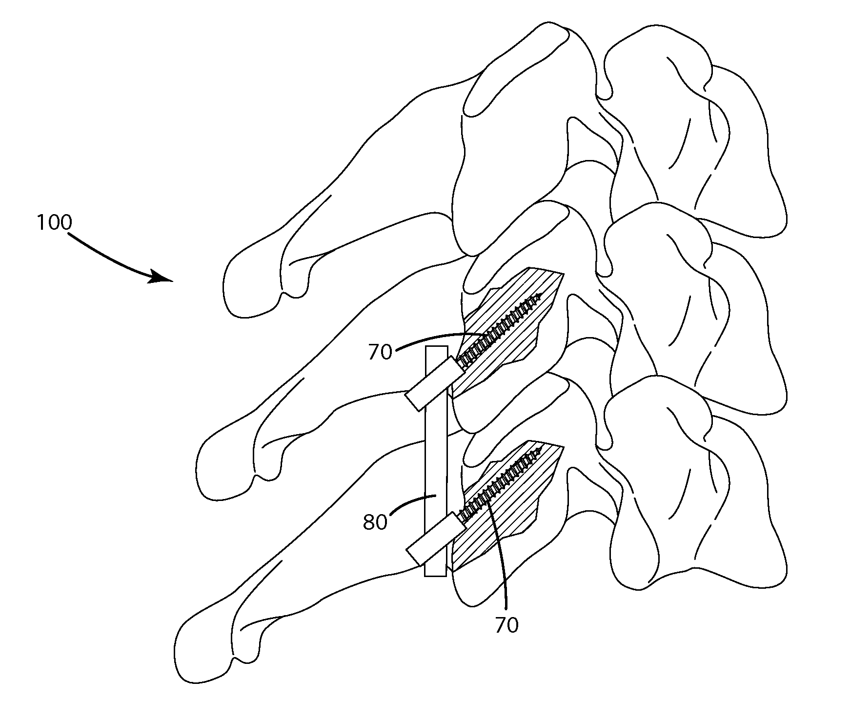 Posterior cervical fusion system and techniques