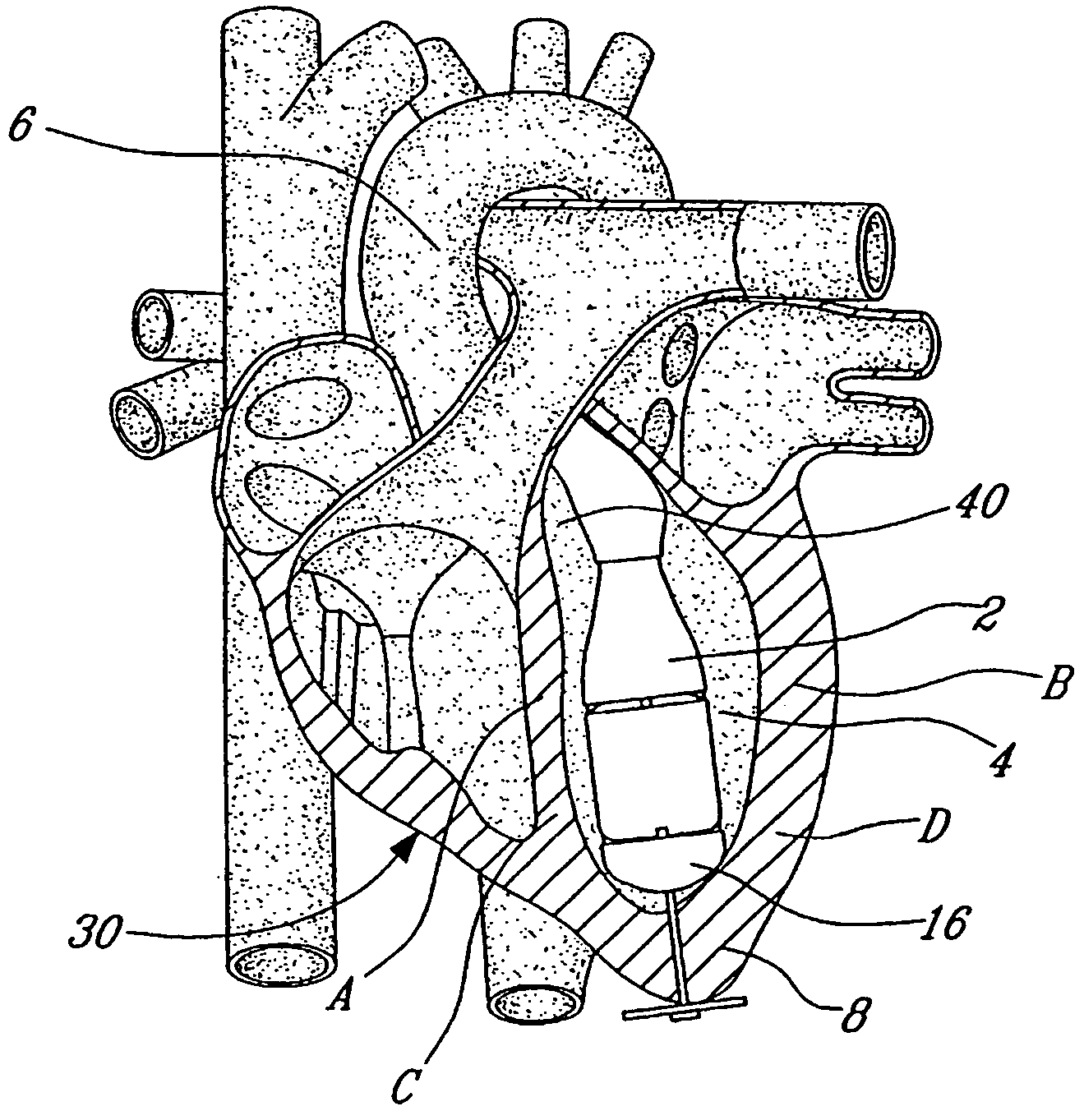 Dual inlet mixed-flow blood pump