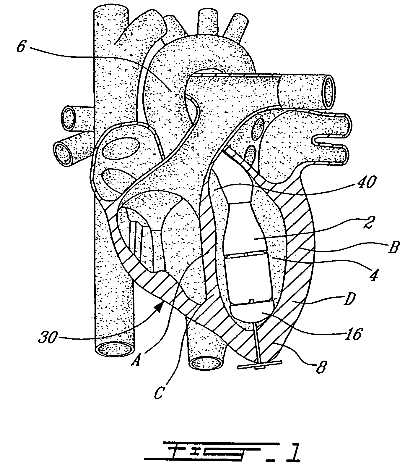 Dual inlet mixed-flow blood pump