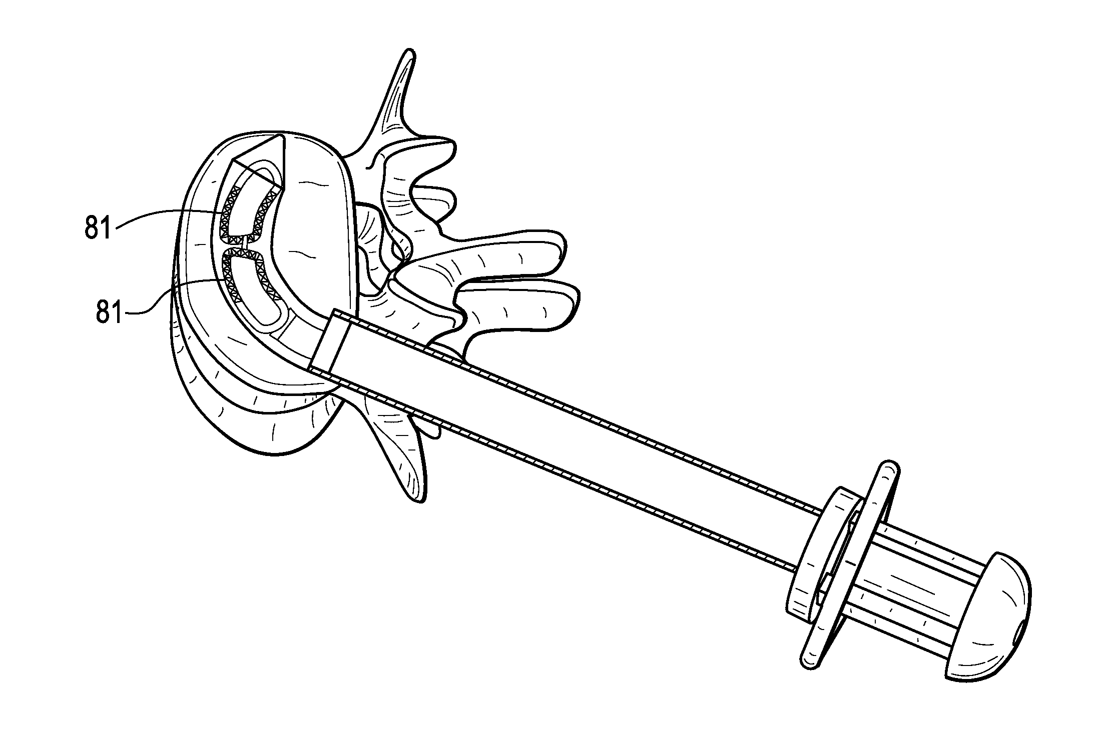 Enhanced Cage Insertion Device