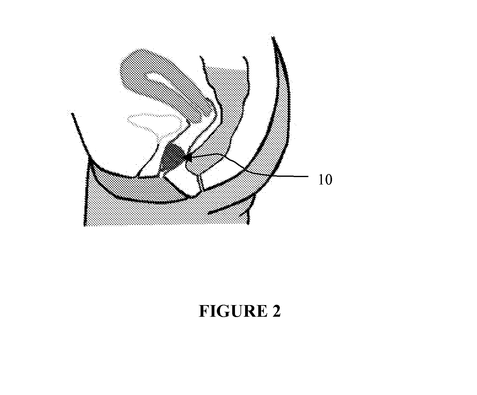 Drogue-like menses collection device