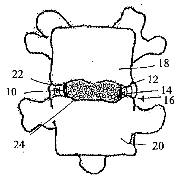 Intervertebral disc restoration